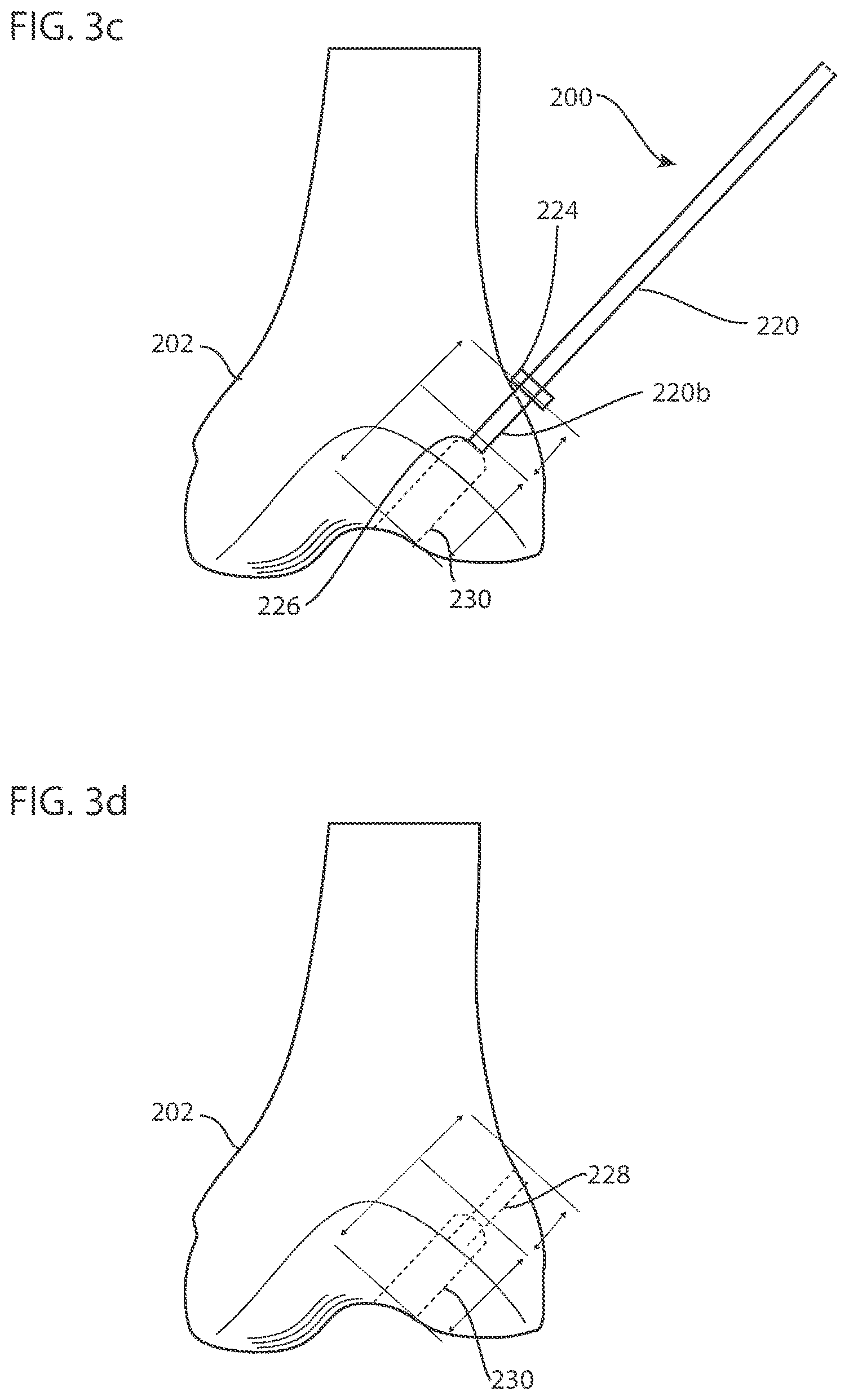 Patent US12102338 Figure 4 – System and method for creating graft tunnels in bone