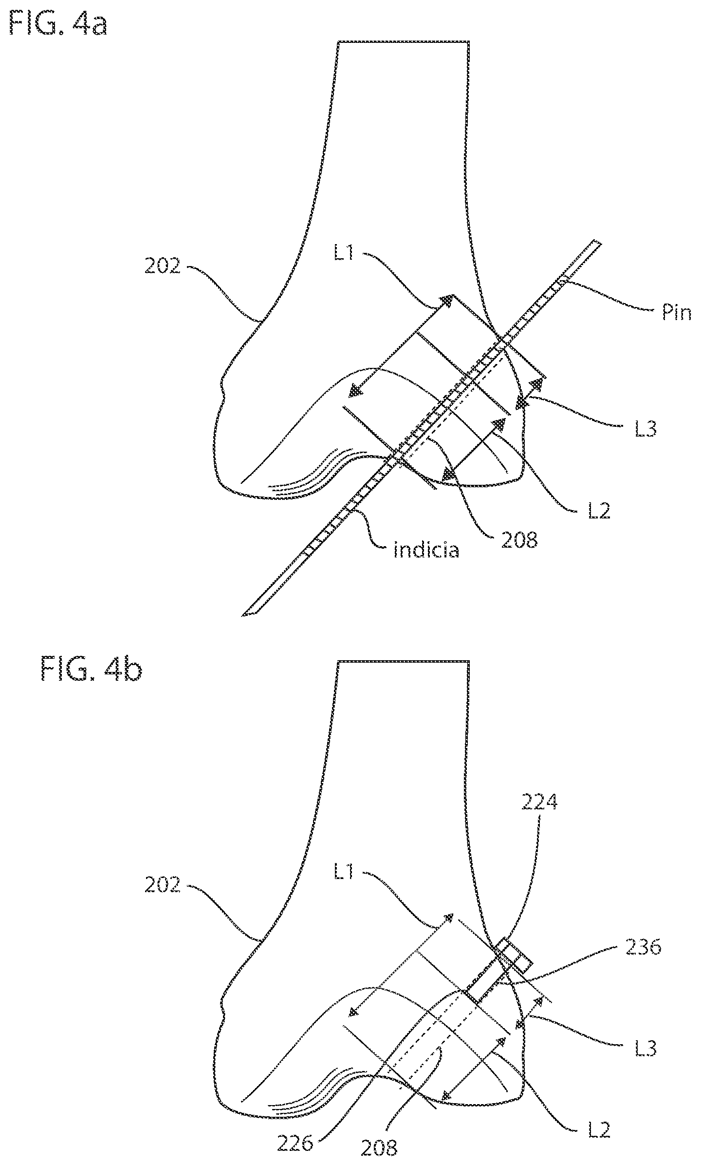 Patent US12102338 Figure 5 – System and method for creating graft tunnels in bone