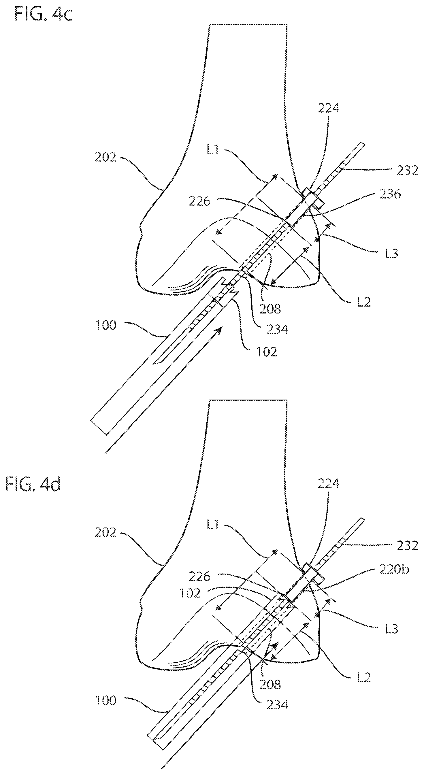 Patent US12102338 Figure 6 – System and method for creating graft tunnels in bone
