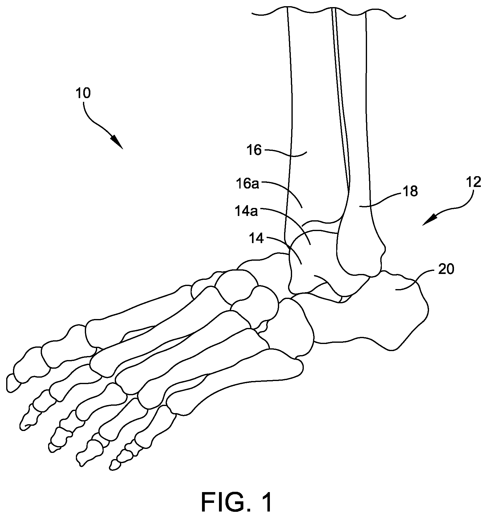 Patent US12102339 — Instrument for intra-operative implant templating using fluoroscopy — Figure 1