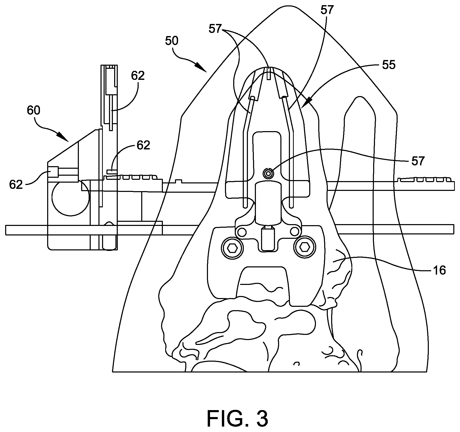 Patent US12102339 Figure 3 – Instrument for intra-operative implant templating using fluoroscopy