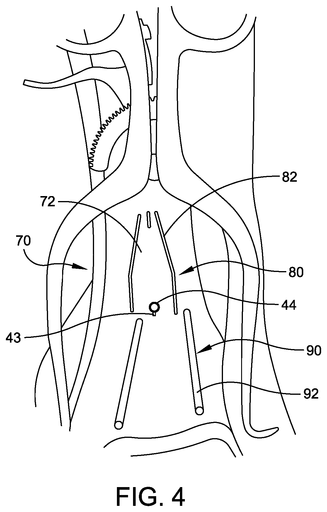 Patent US12102339 Figure 4 – Instrument for intra-operative implant templating using fluoroscopy
