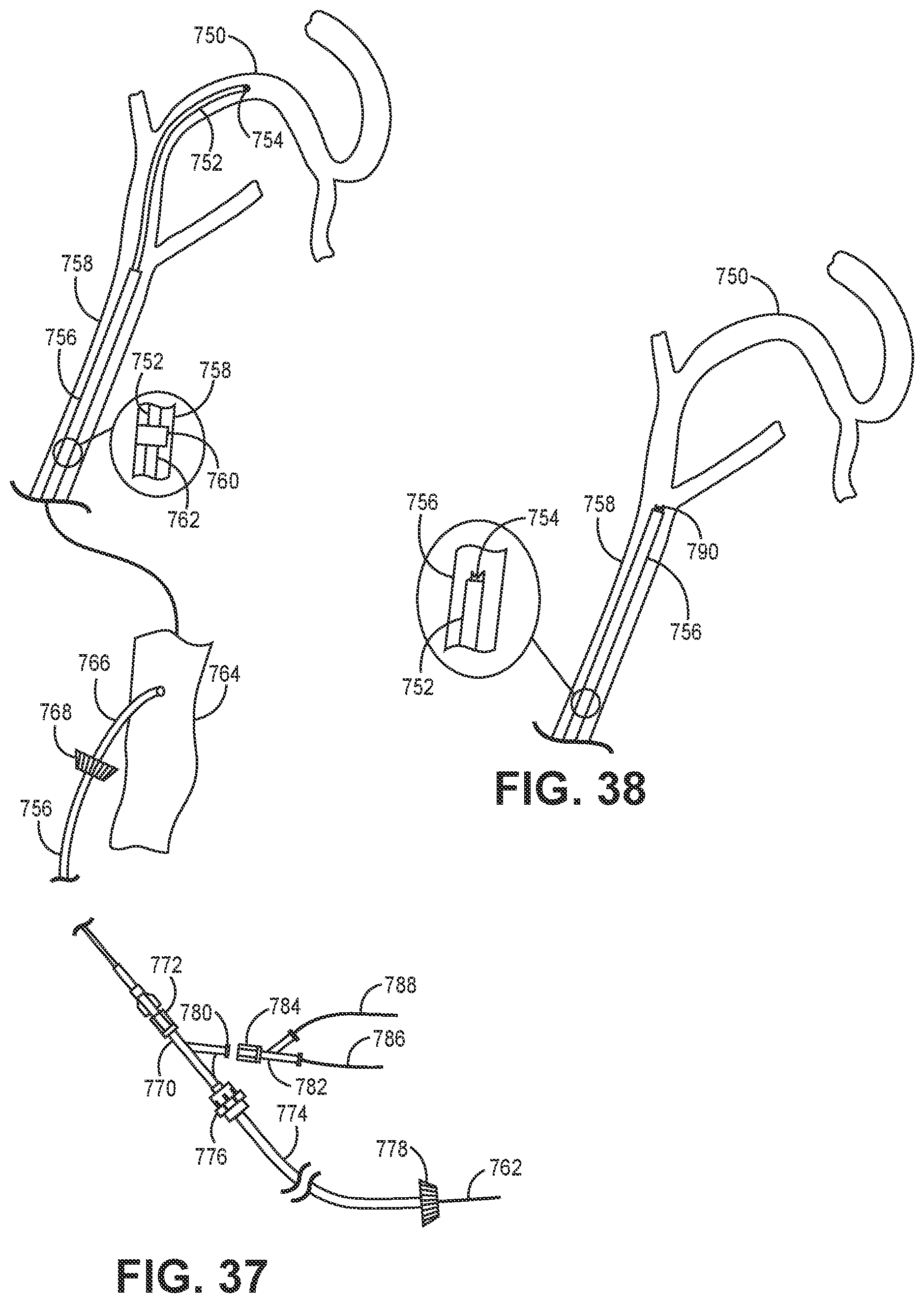 Patent US12102341 Figure 12 – Suction catheter systems for applying effective aspiration in remote vessels, especially cerebral arteries