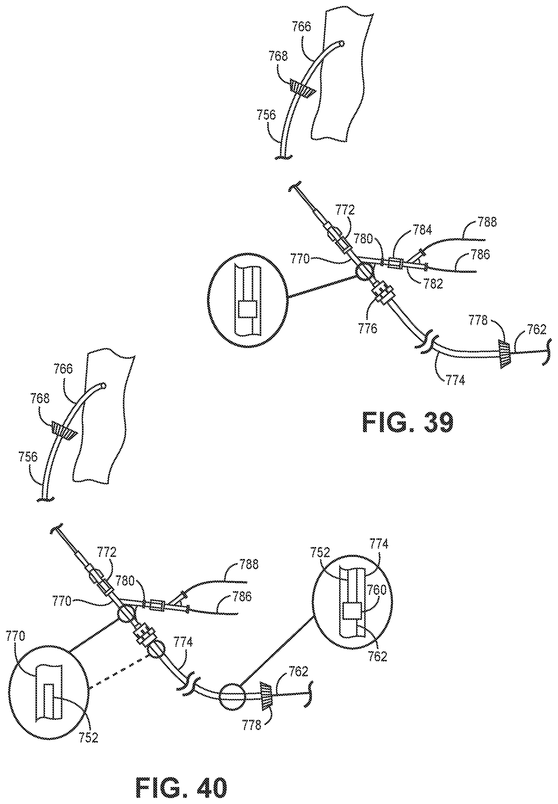 Patent US12102341 Figure 13 – Suction catheter systems for applying effective aspiration in remote vessels, especially cerebral arteries