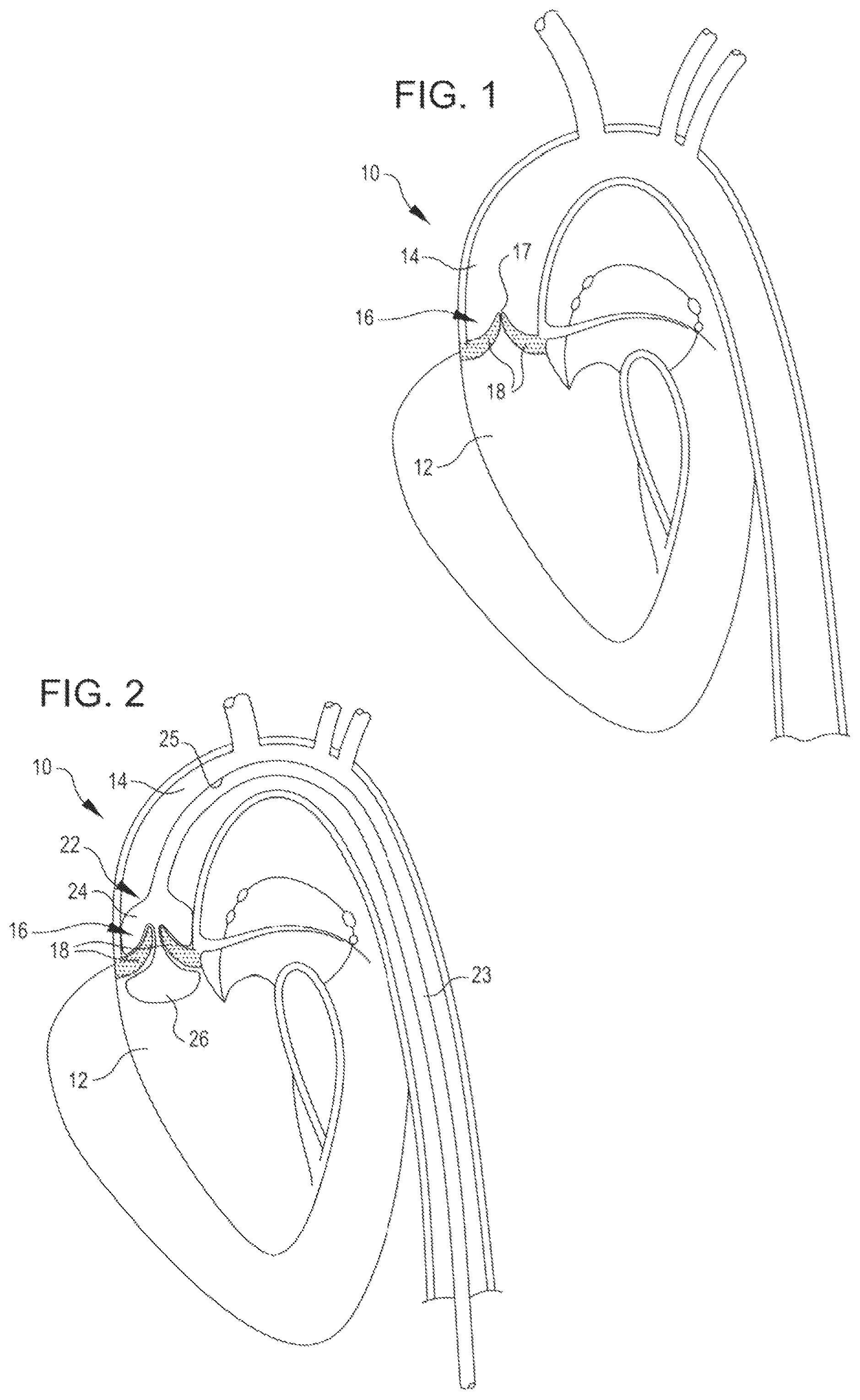 Patent US12102342 — Shockwave valvuloplasty catheter system — Figure 1