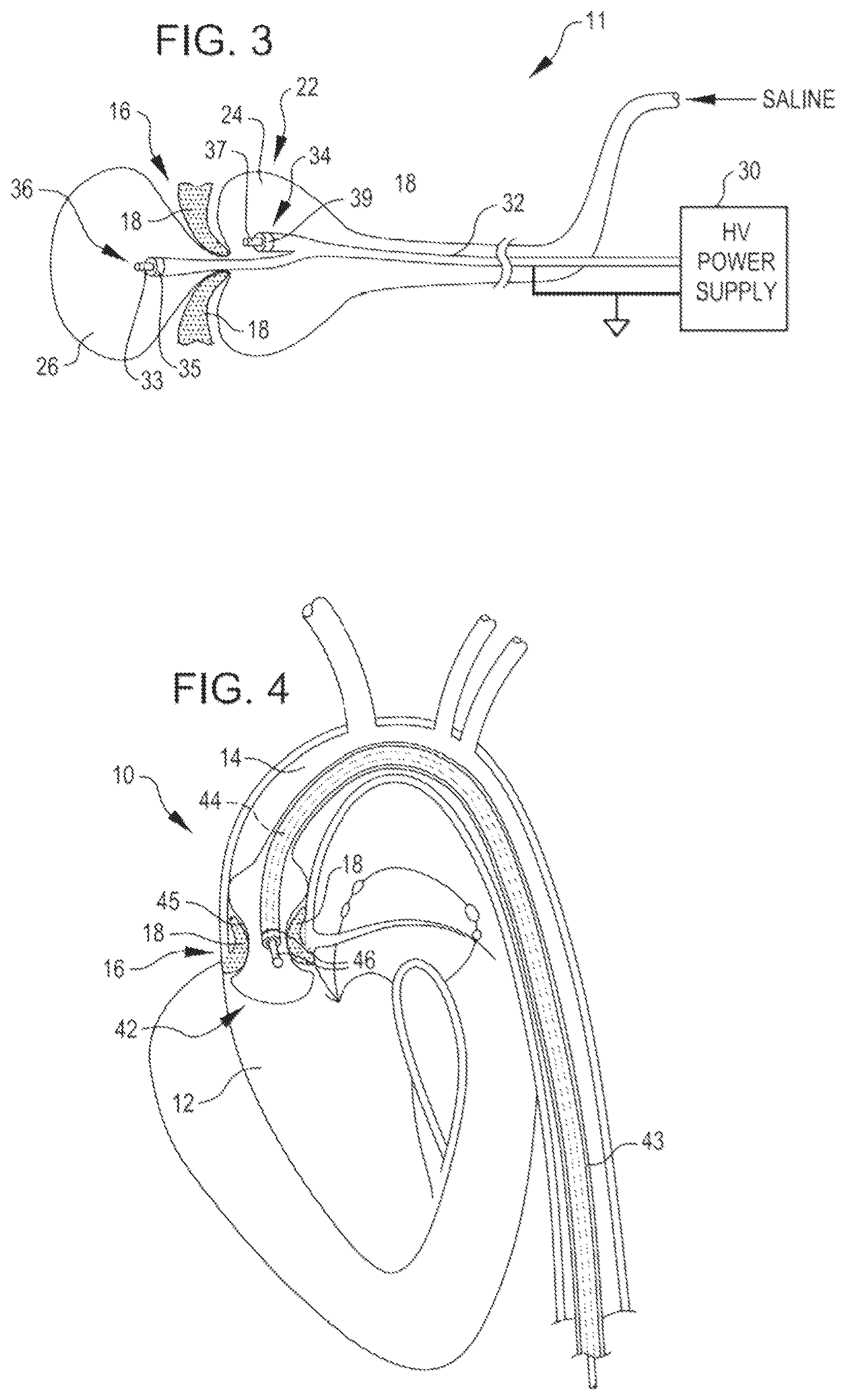 Patent US12102342 Figure 2 – Shockwave valvuloplasty catheter system