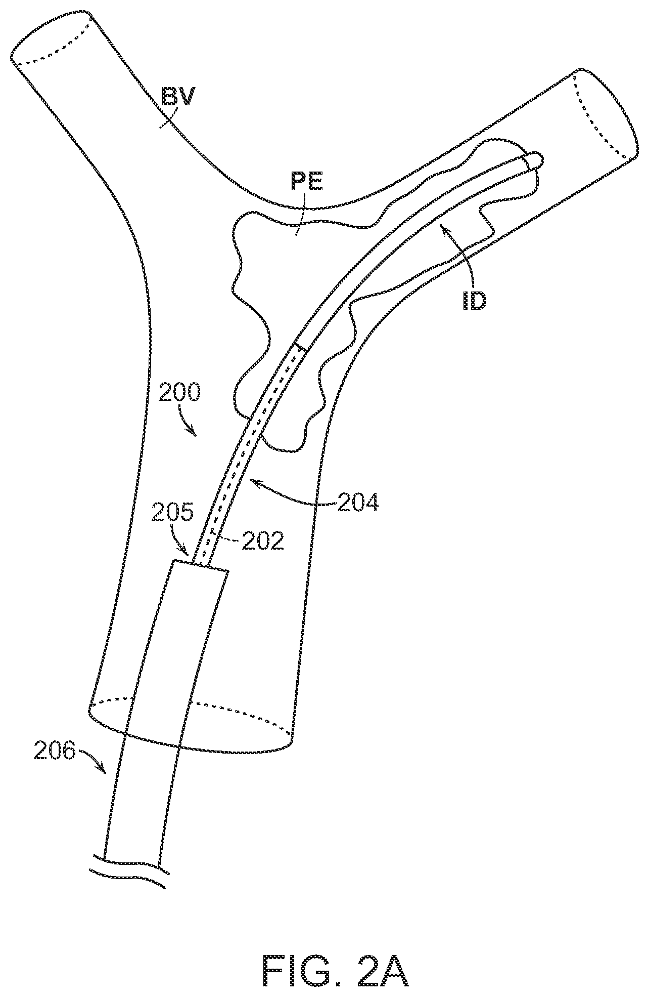 Patent US12102343 Figure 3 – Single insertion delivery system for treating embolism and associated systems and methods