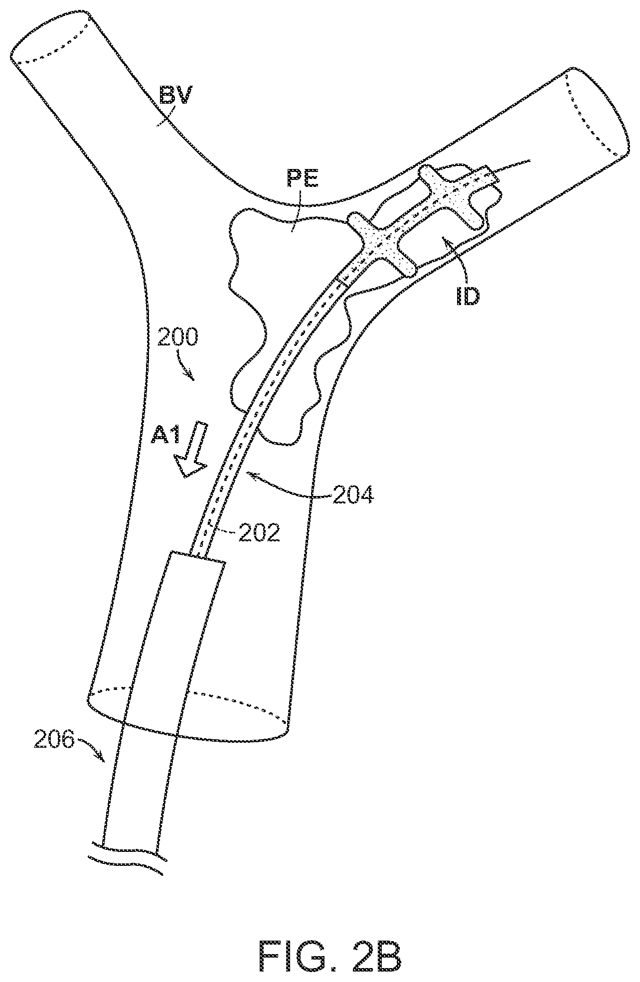 Patent US12102343 Figure 4 – Single insertion delivery system for treating embolism and associated systems and methods