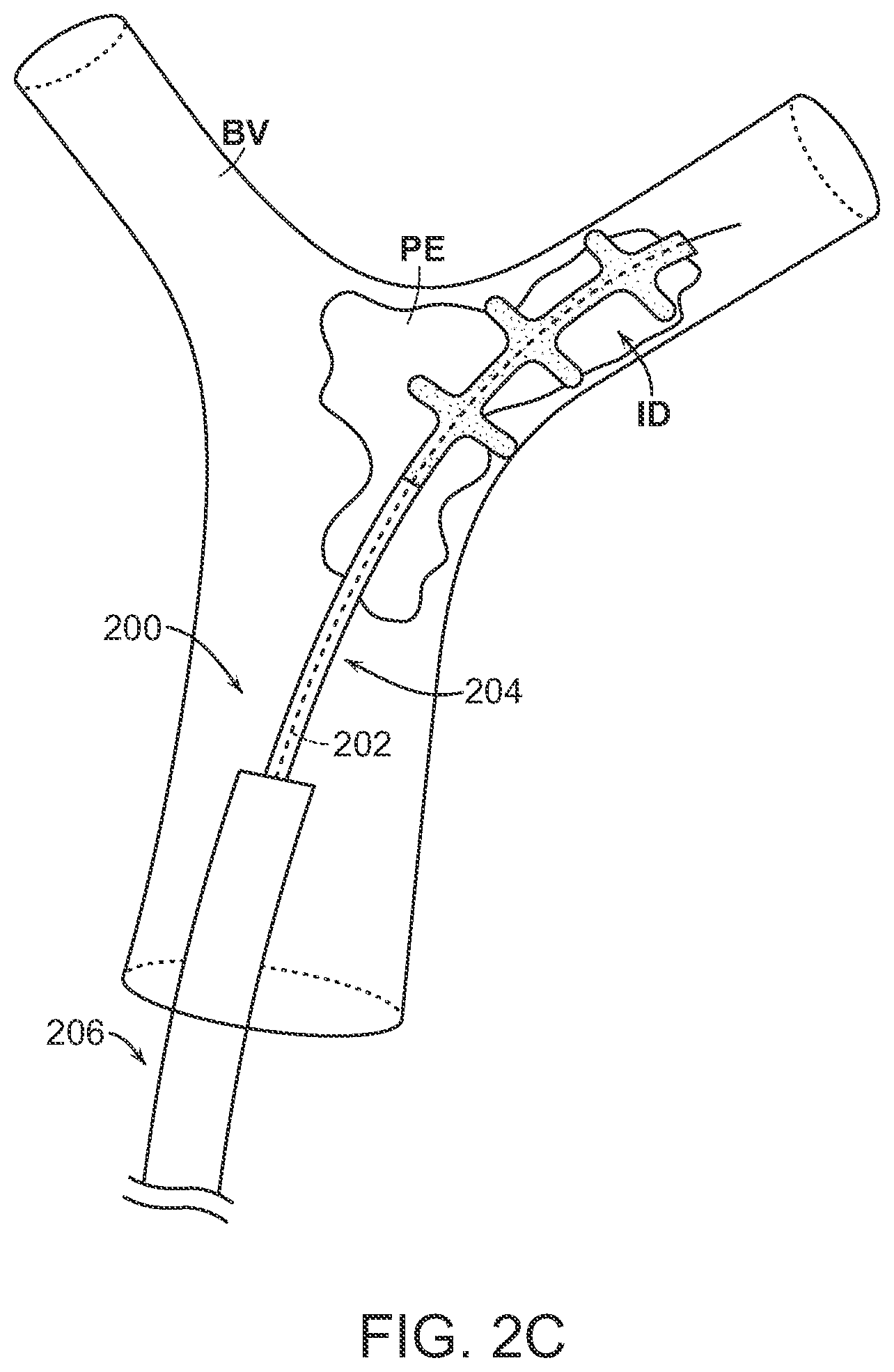 Patent US12102343 Figure 5 – Single insertion delivery system for treating embolism and associated systems and methods