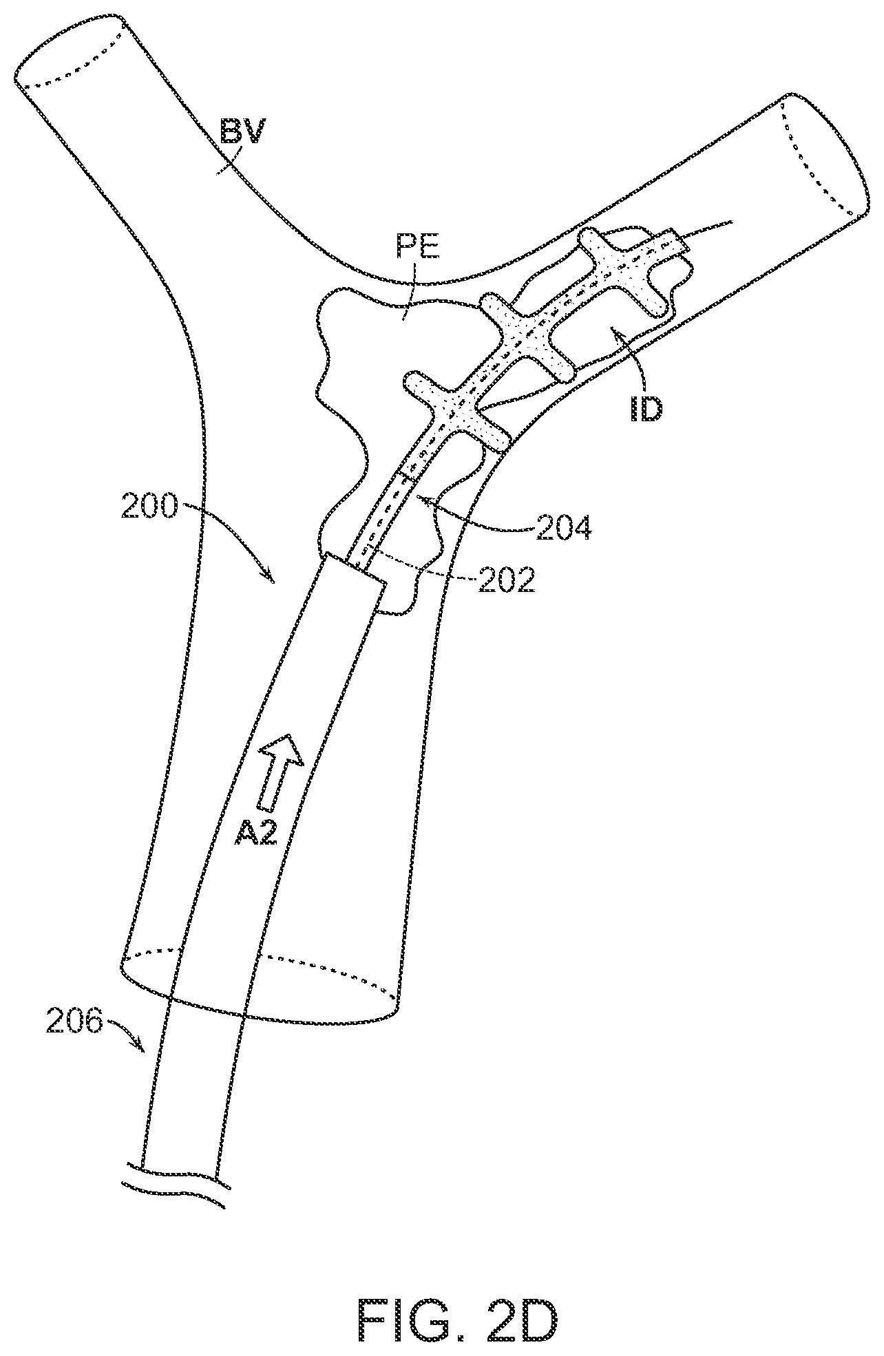 Patent US12102343 Figure 6 – Single insertion delivery system for treating embolism and associated systems and methods