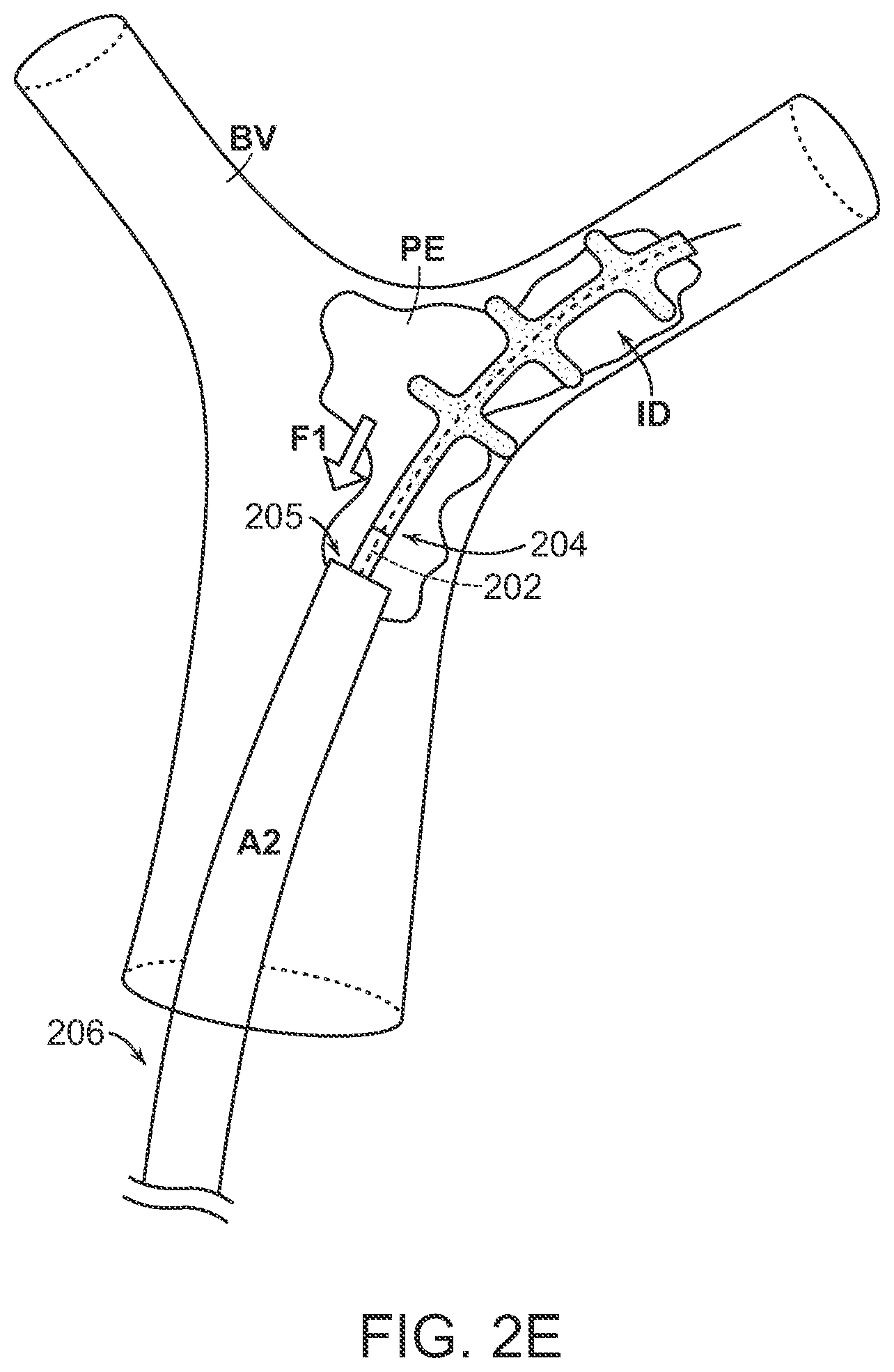Patent US12102343 Figure 7 – Single insertion delivery system for treating embolism and associated systems and methods