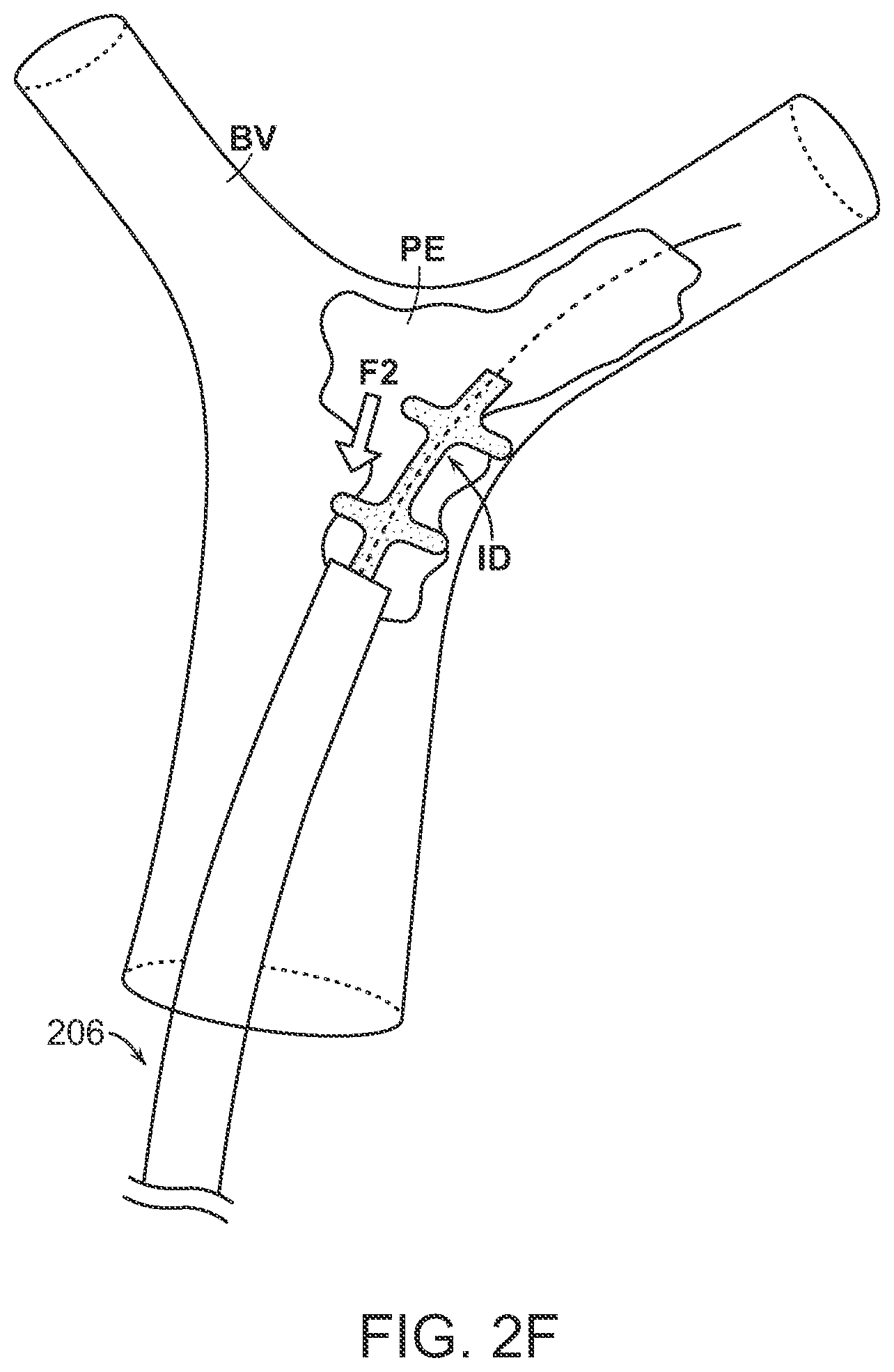 Patent US12102343 Figure 8 – Single insertion delivery system for treating embolism and associated systems and methods