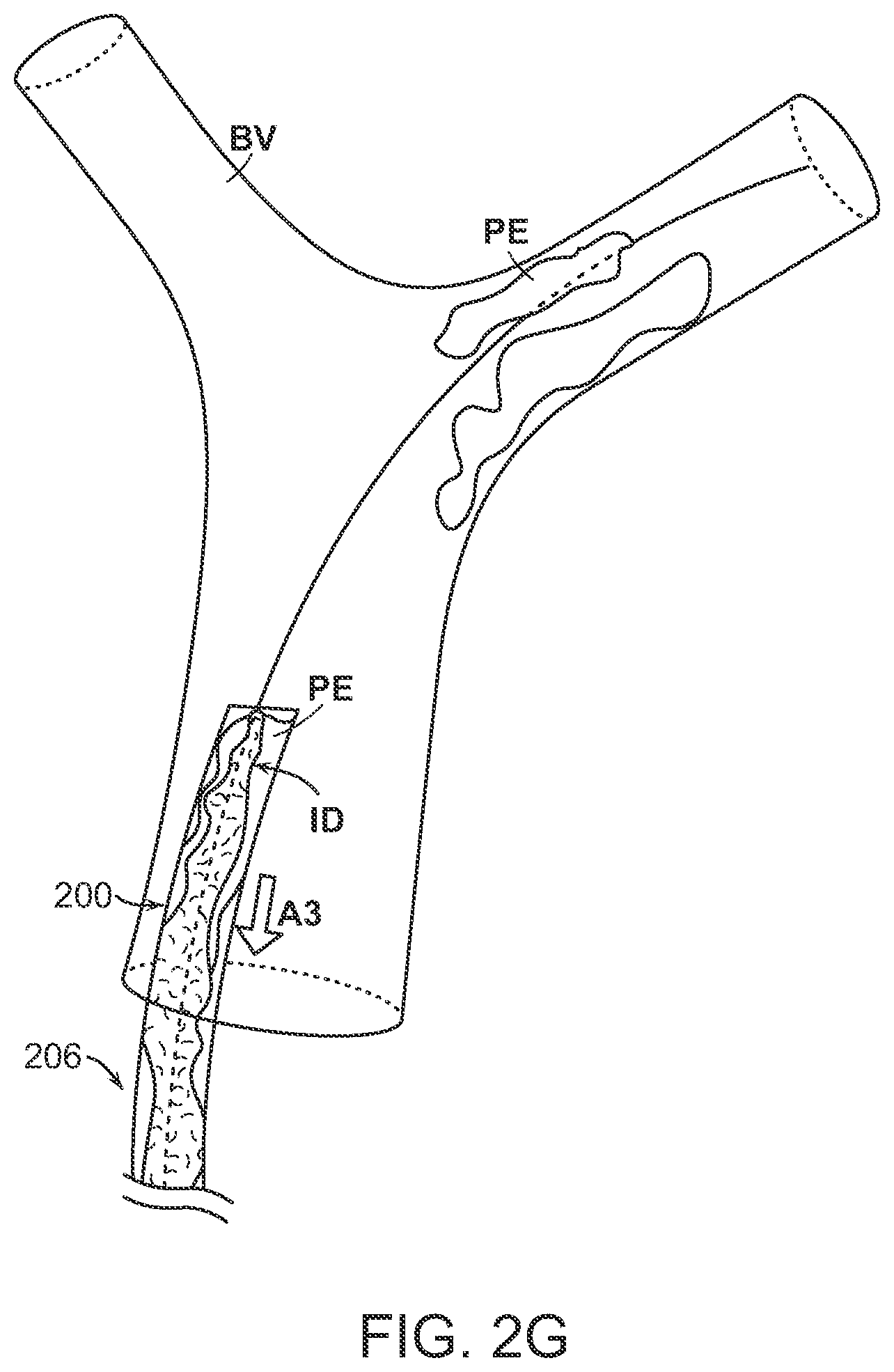 Patent US12102343 Figure 9 – Single insertion delivery system for treating embolism and associated systems and methods