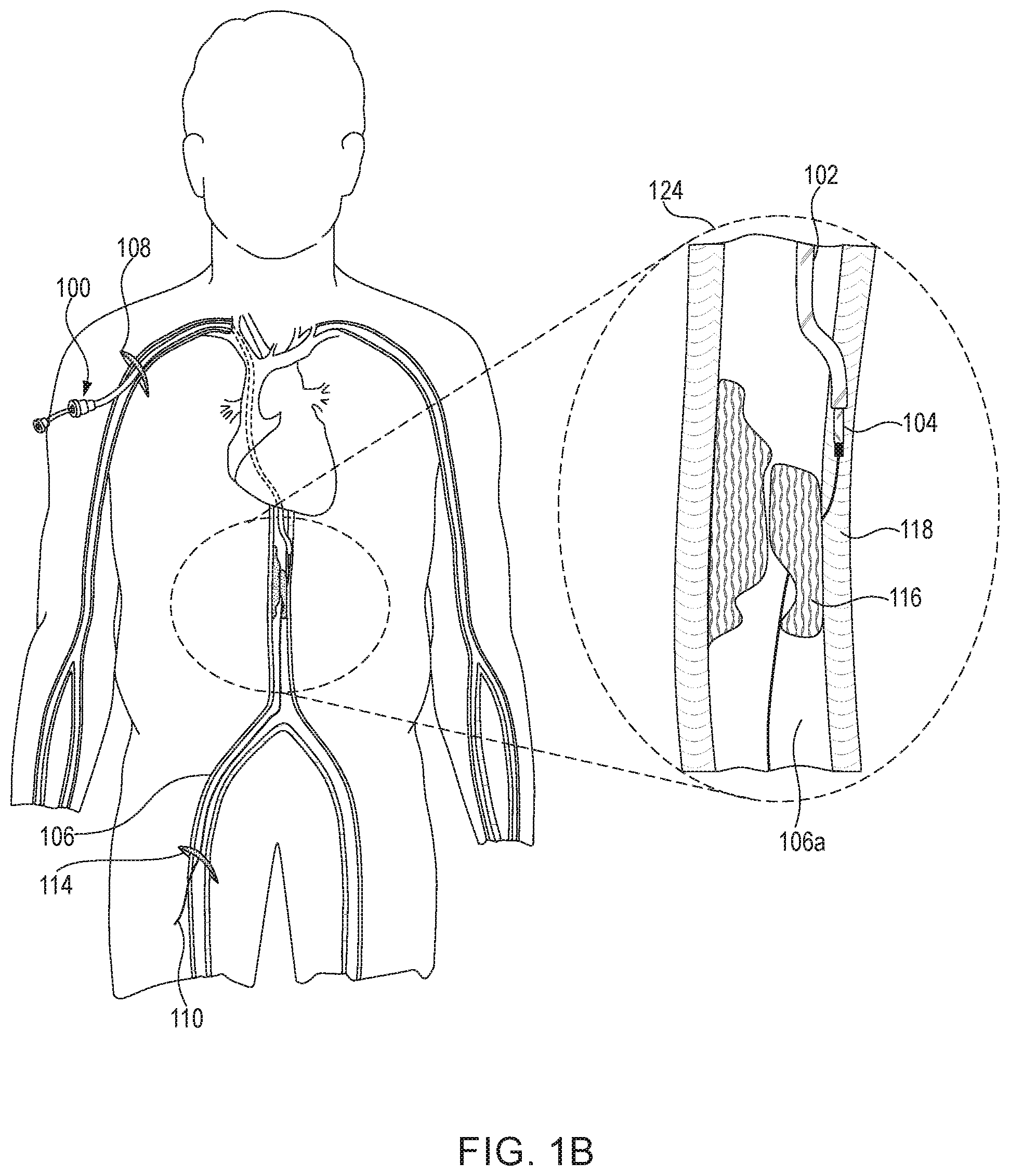 Patent US12102344 Figure 2 – Medical device for snaring guidewire