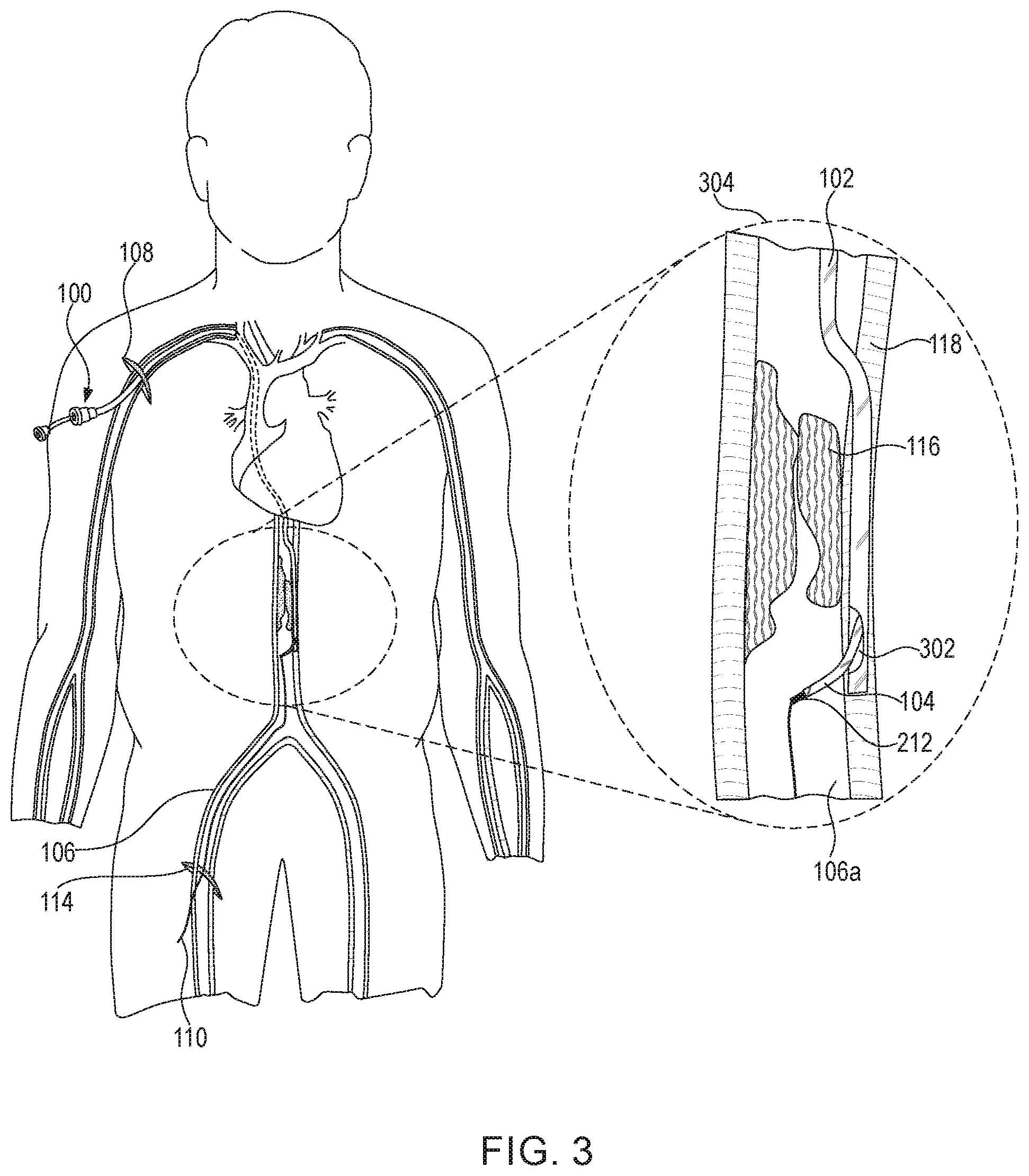 Patent US12102344 Figure 4 – Medical device for snaring guidewire