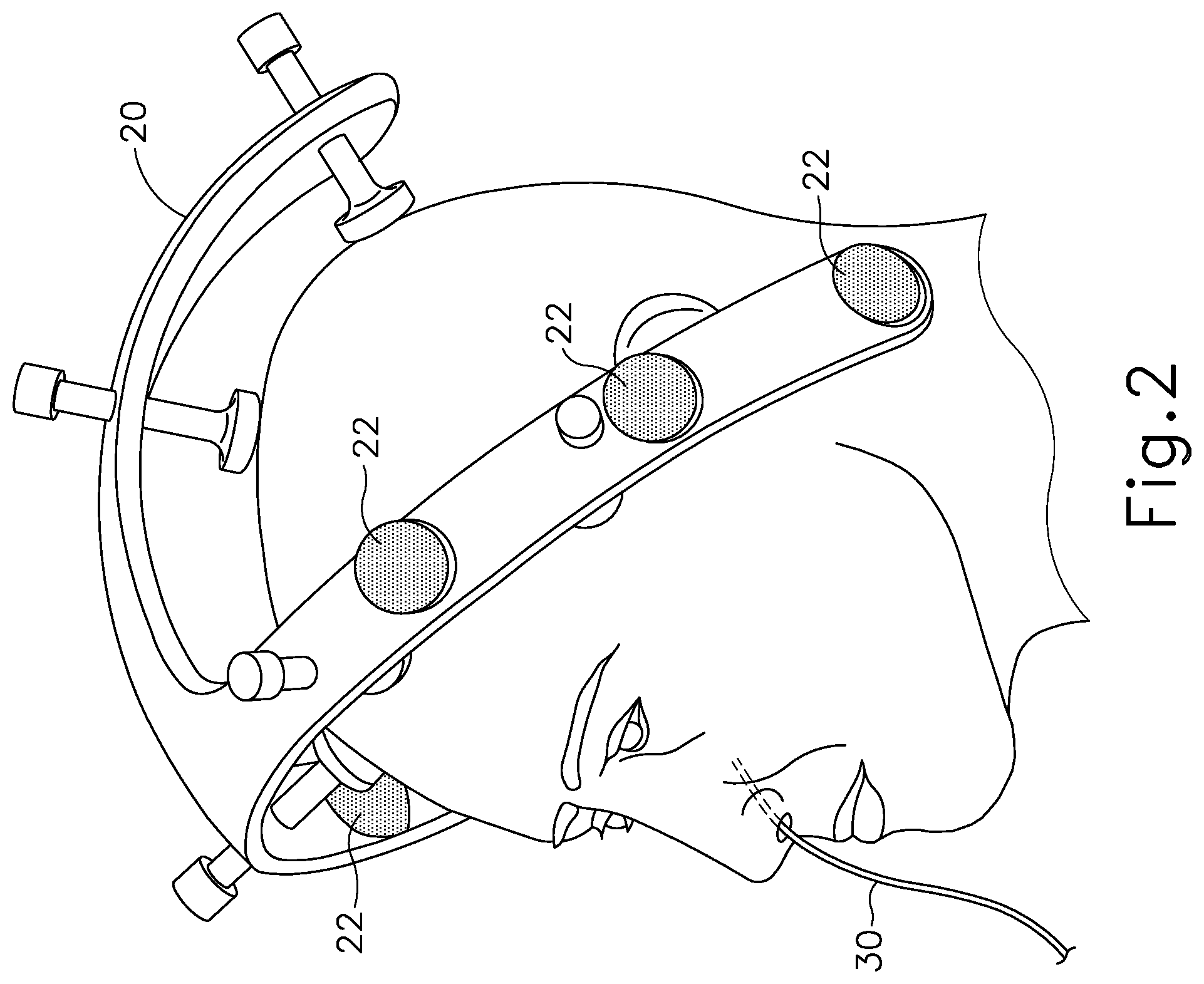 Patent US12102345 Figure 2 – Navigable suction instrument with coaxial annular sensor