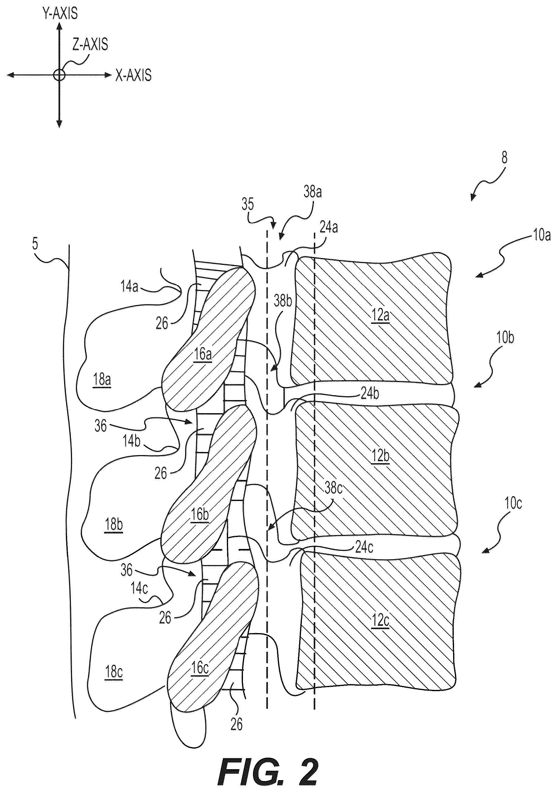 Patent US12102348 Figure 2 – Percutaneous lateral recess resection methods and instruments