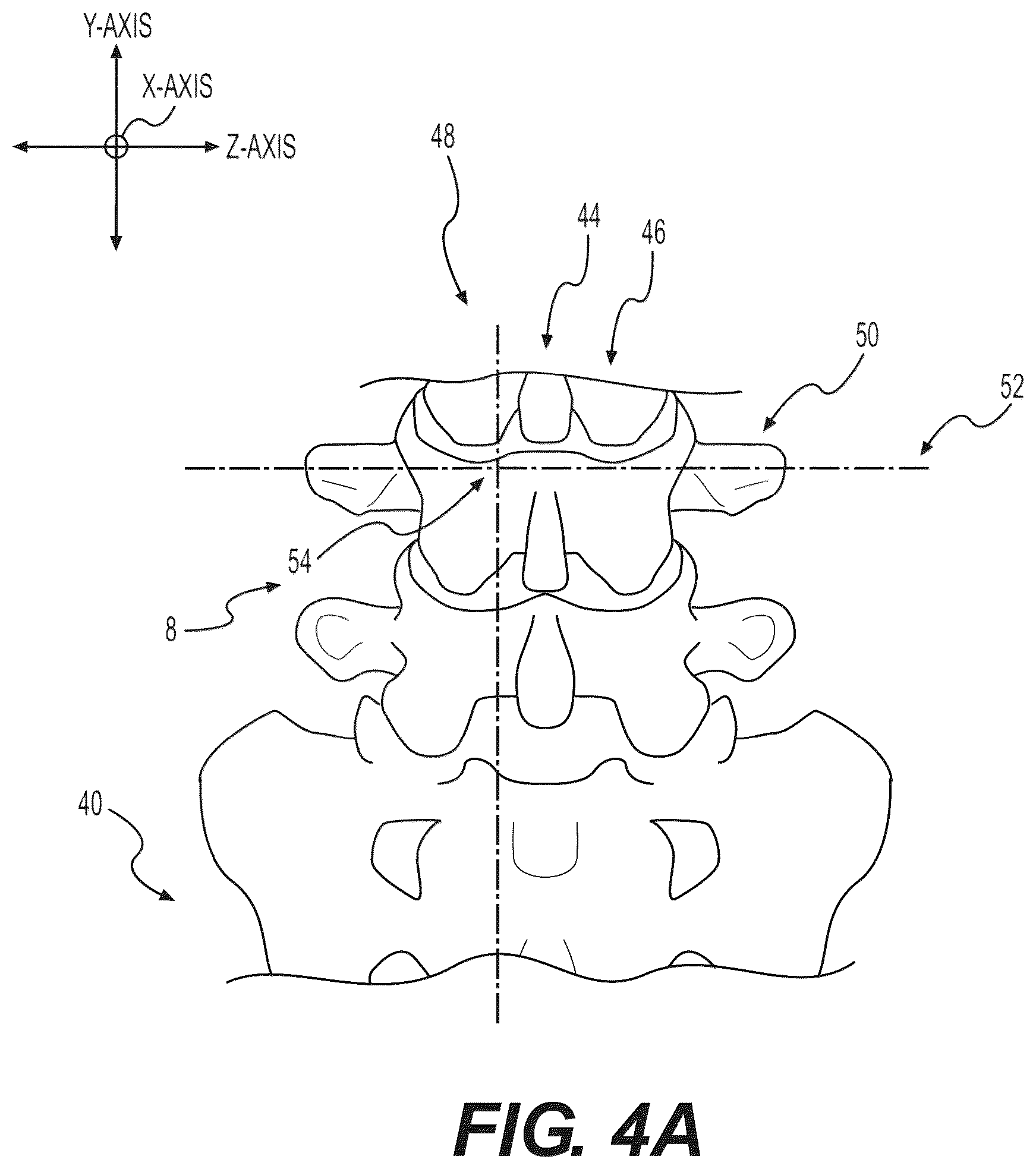 Patent US12102348 Figure 10 – Percutaneous lateral recess resection methods and instruments