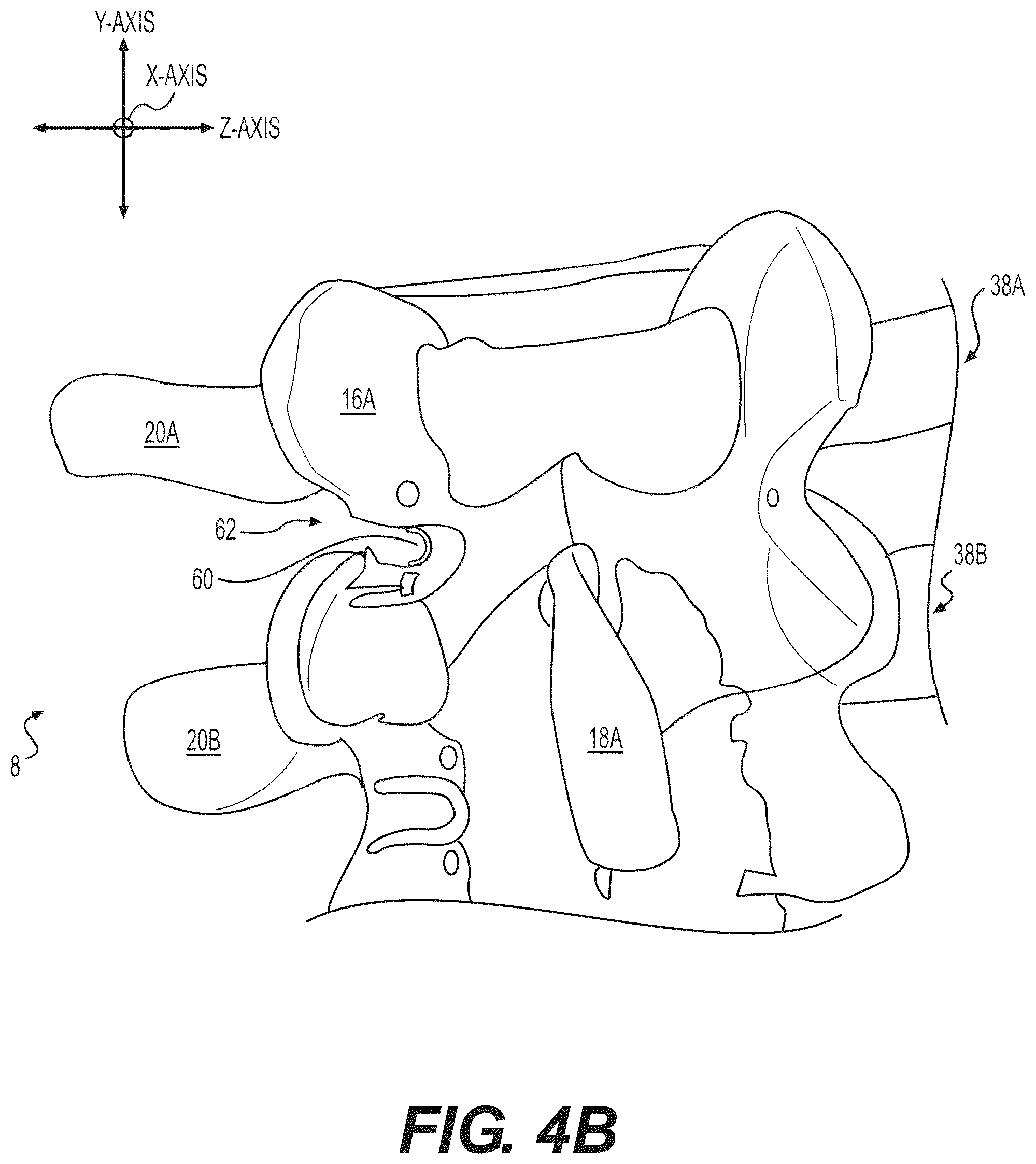 Patent US12102348 Figure 11 – Percutaneous lateral recess resection methods and instruments