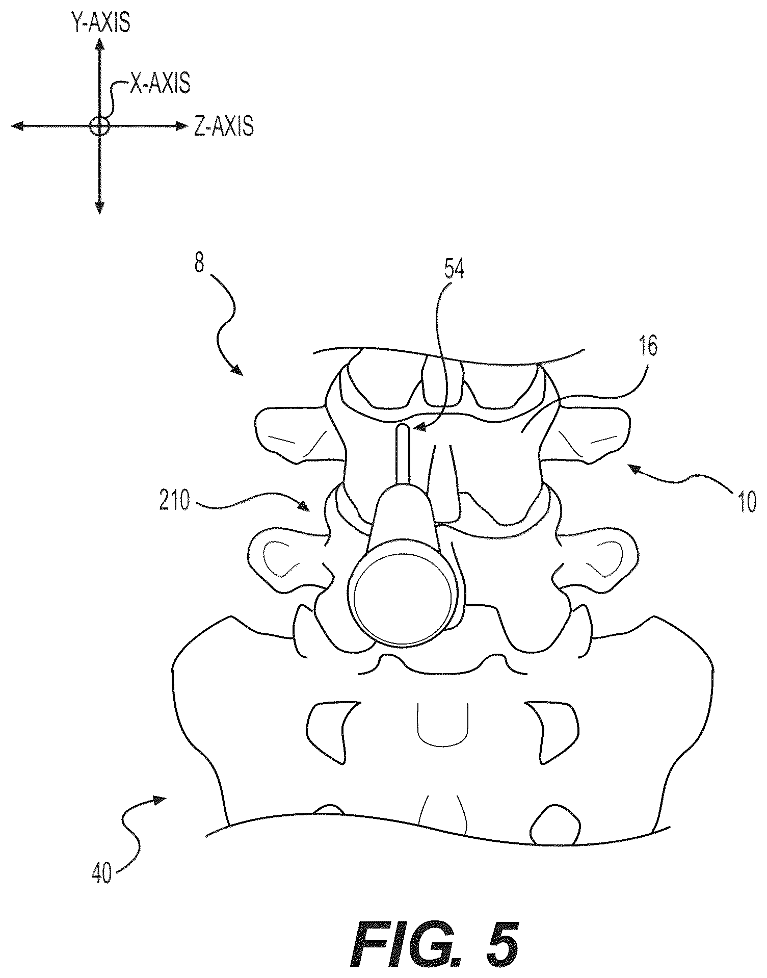 Patent US12102348 Figure 12 – Percutaneous lateral recess resection methods and instruments