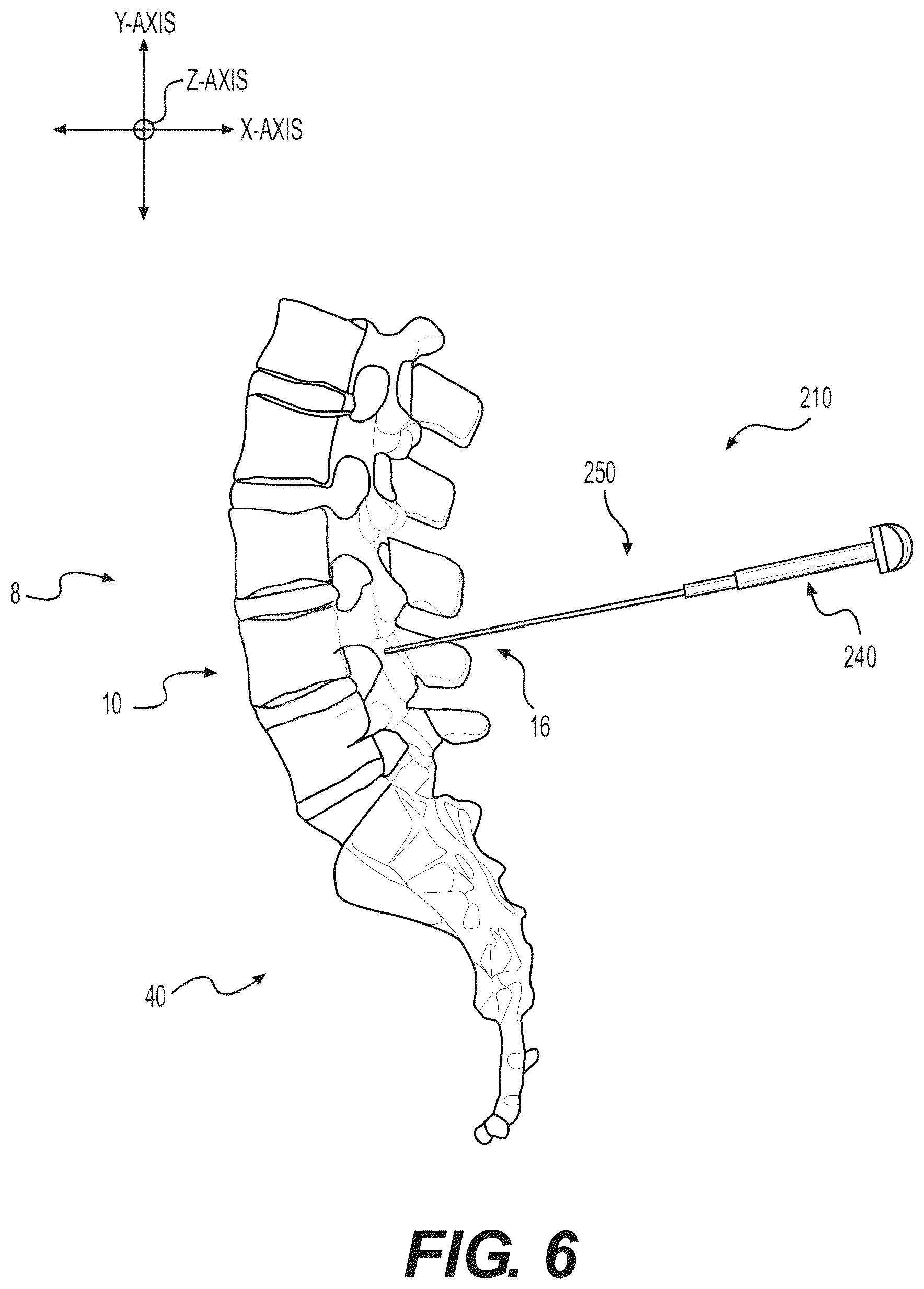 Patent US12102348 Figure 13 – Percutaneous lateral recess resection methods and instruments