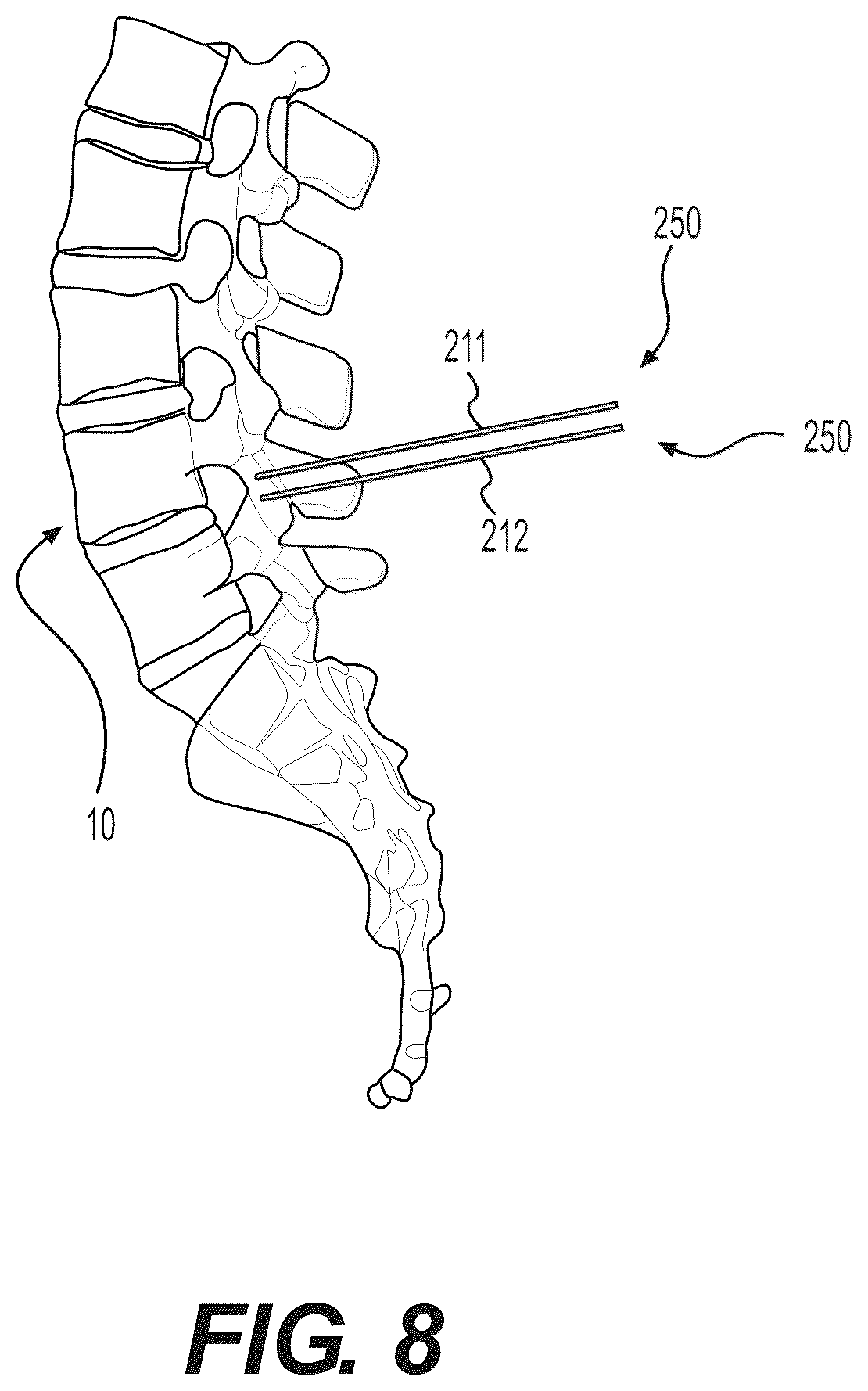 Patent US12102348 Figure 15 – Percutaneous lateral recess resection methods and instruments