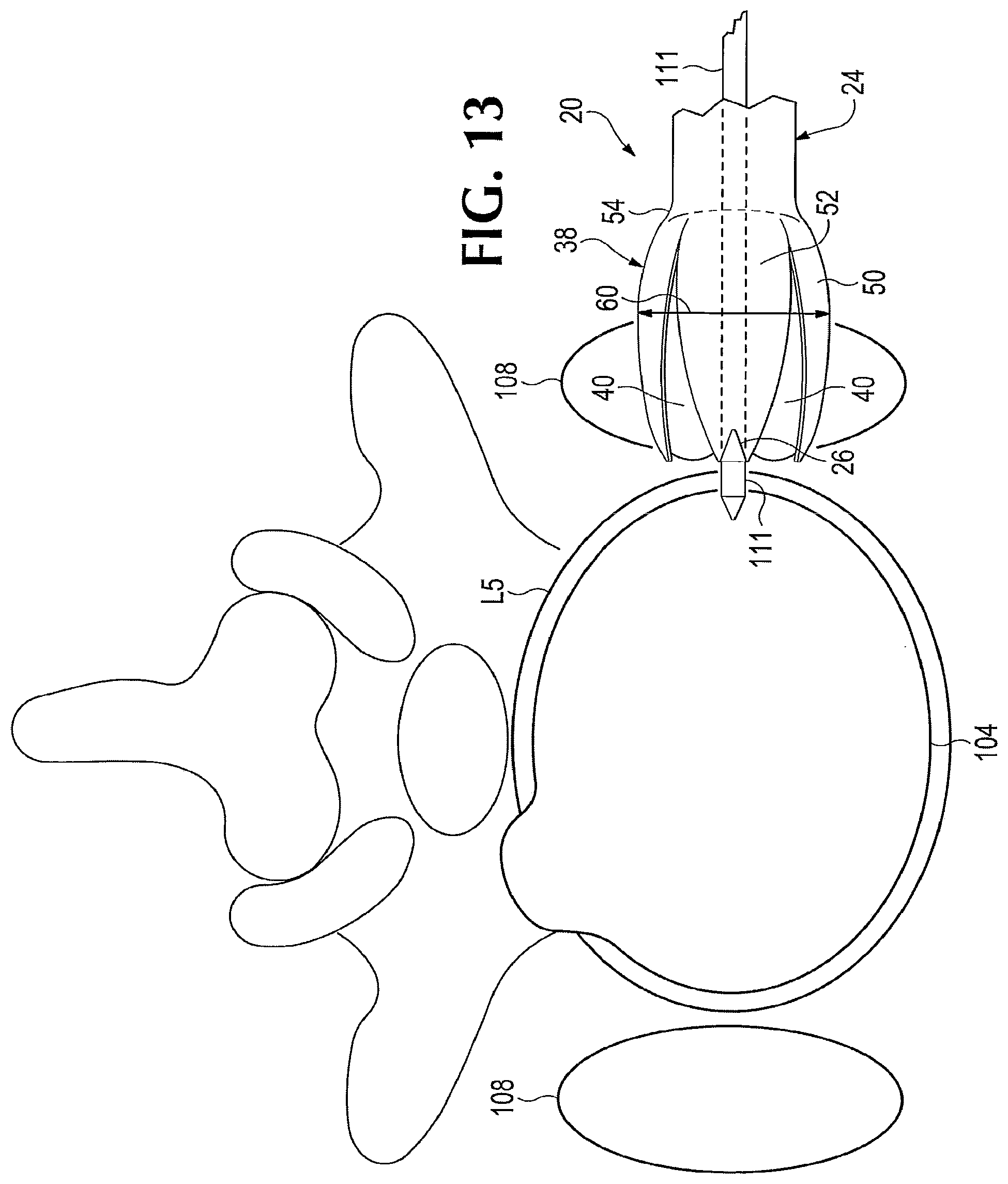 Patent US12102351 Figure 8 – Surgical probe incorporating a dilator