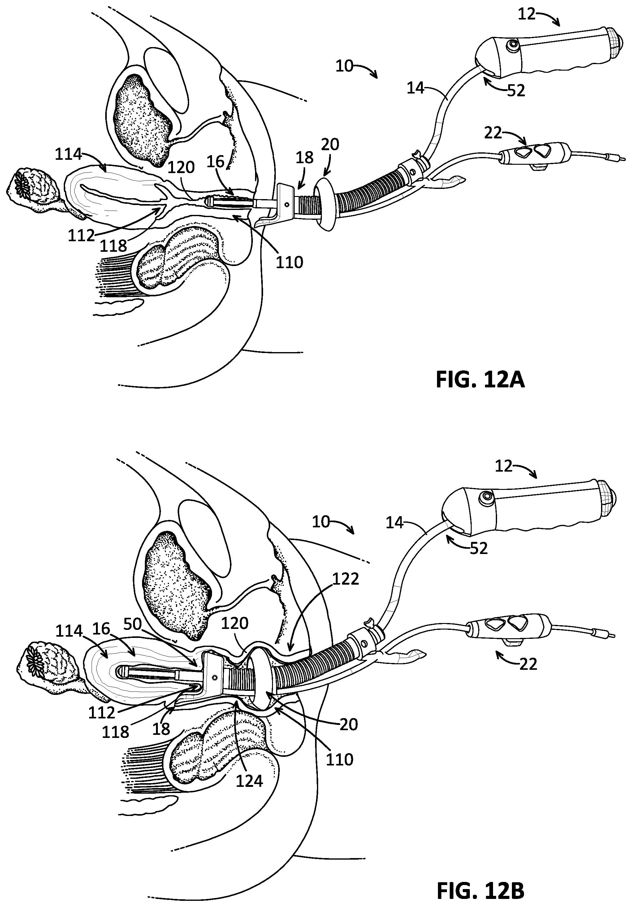 Patent US12102355 Figure 9 – Uterine manipulator with cutting head