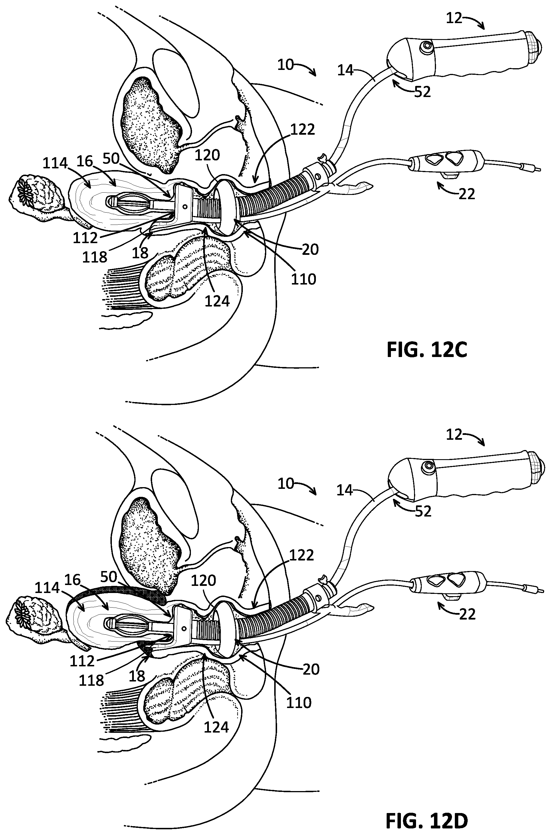 Patent US12102355 Figure 10 – Uterine manipulator with cutting head