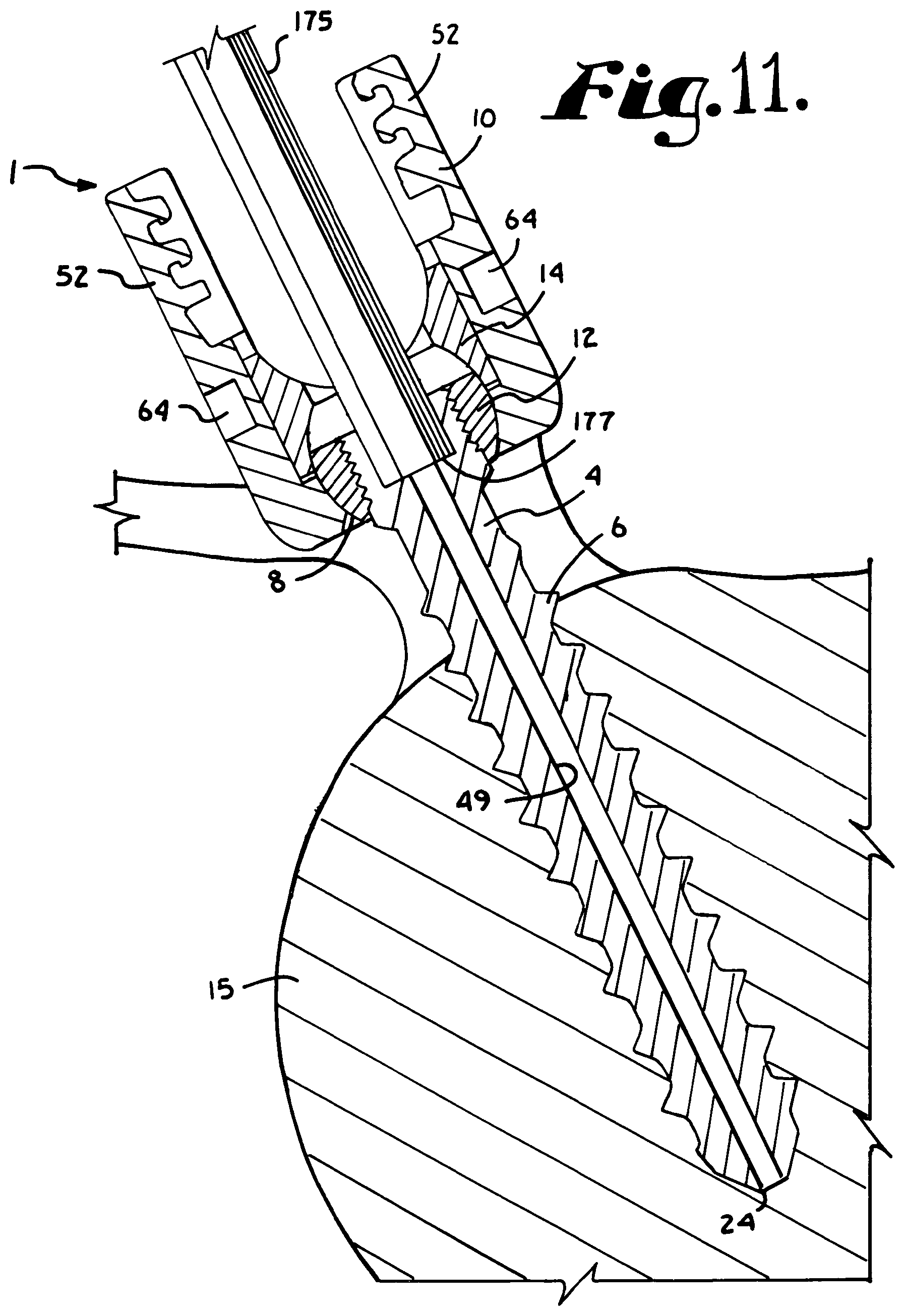 Patent US12102357 Figure 4 – Pivotal bone anchor assembly with cannulated shank having a planar top surface and method of assembly