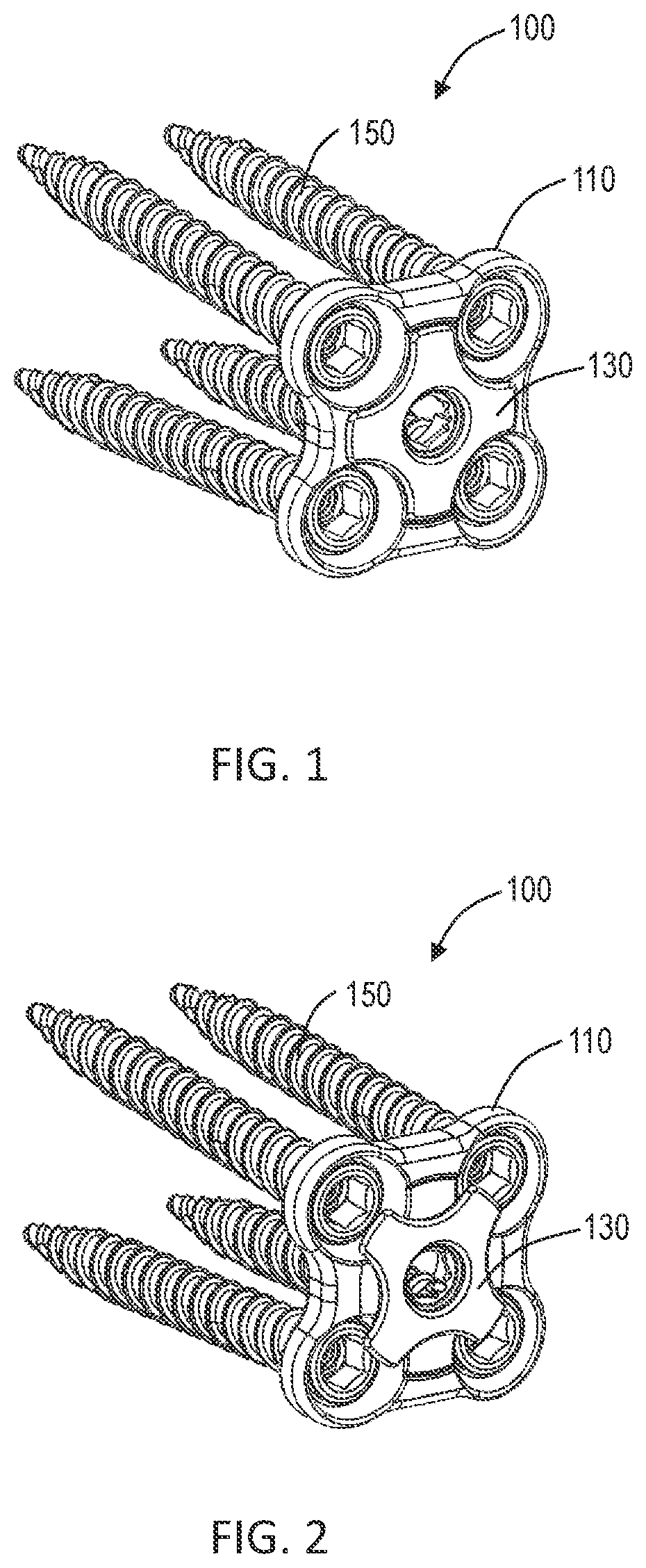 Patent US12102358 Figure 1 – Lateral vertebral lumbar plate system with integrated rotational control mechanism for screw retention