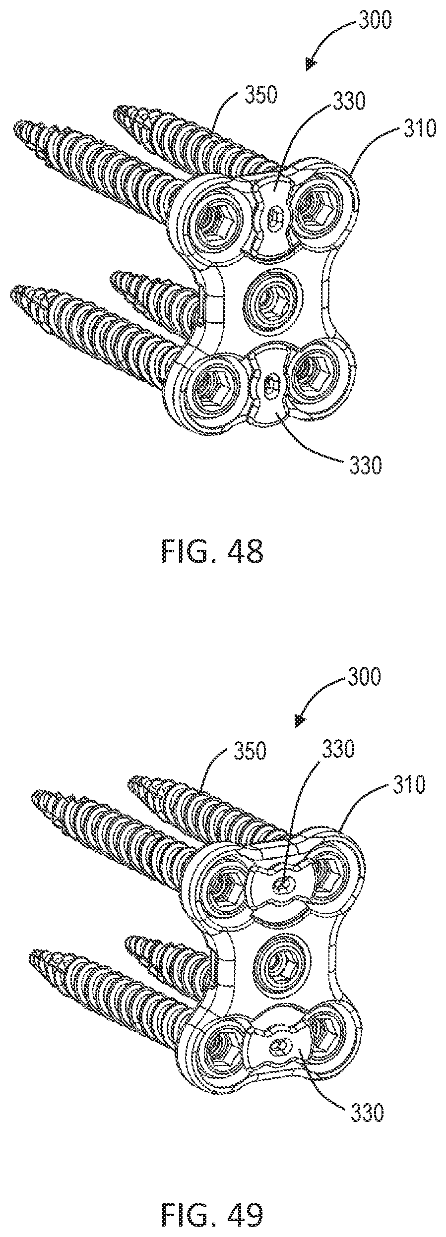 Patent US12102358 Figure 15 – Lateral vertebral lumbar plate system with integrated rotational control mechanism for screw retention