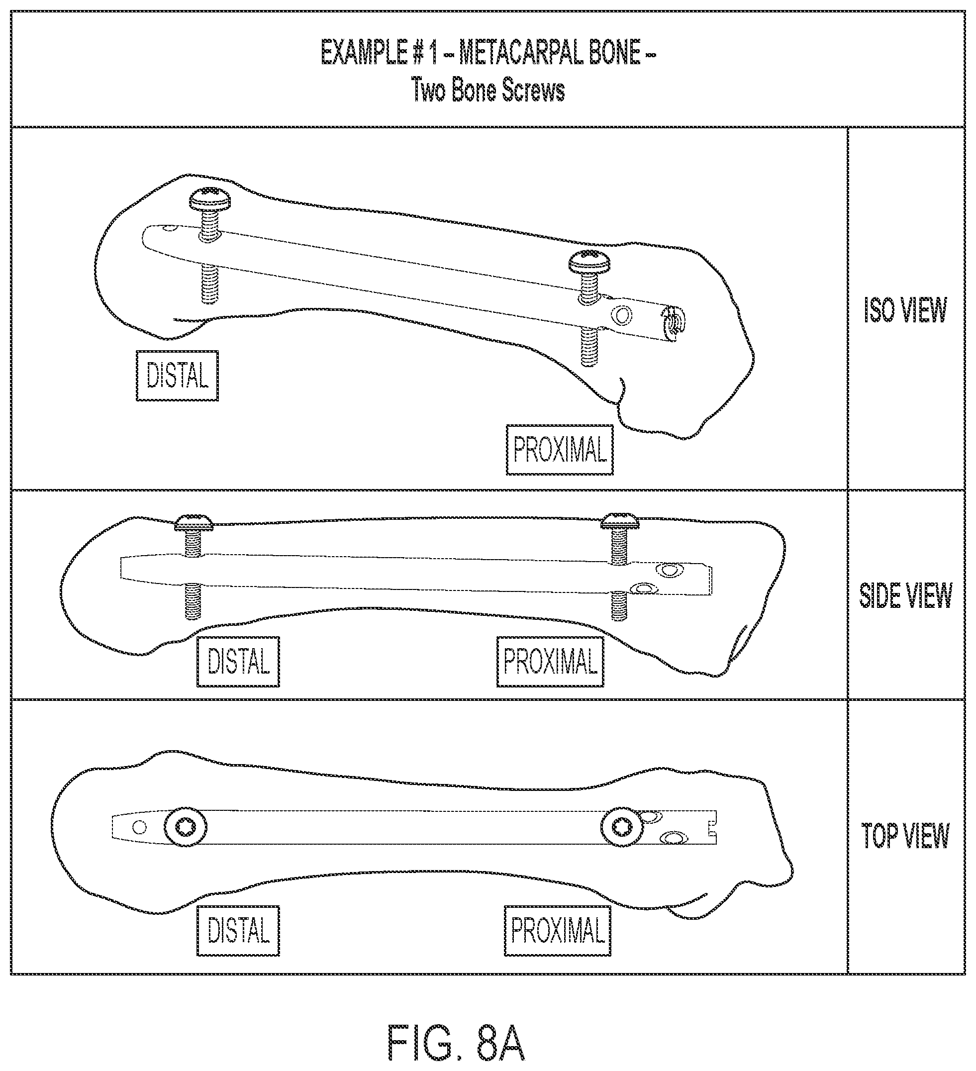Patent US12102359 Figure 11 – Intramedullary fixation nail and method of use