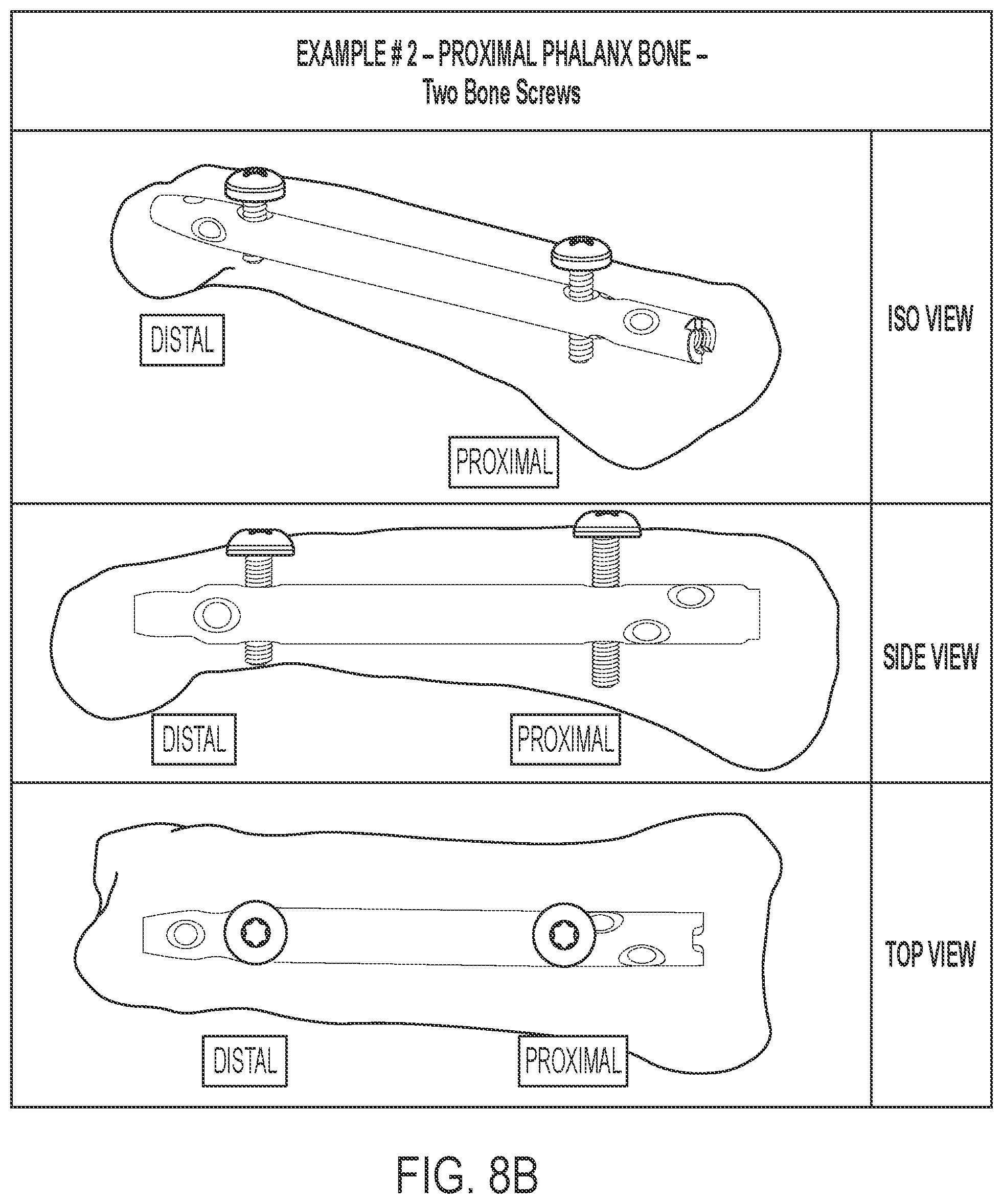 Patent US12102359 Figure 12 – Intramedullary fixation nail and method of use