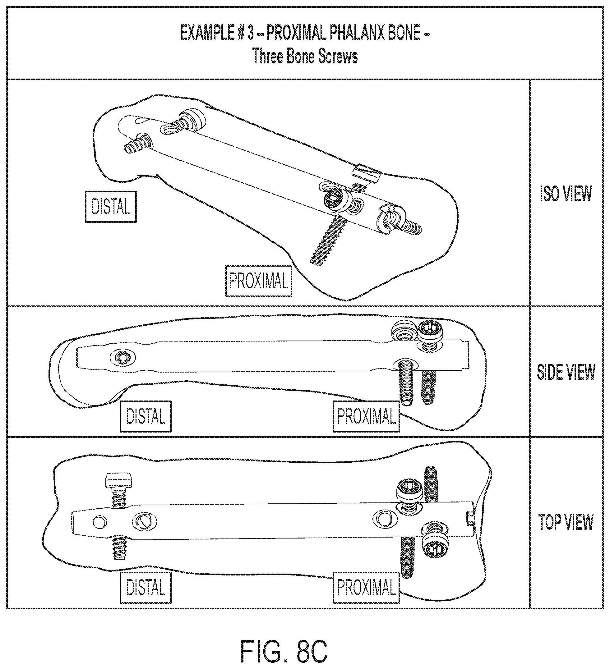Patent US12102359 Figure 13 – Intramedullary fixation nail and method of use