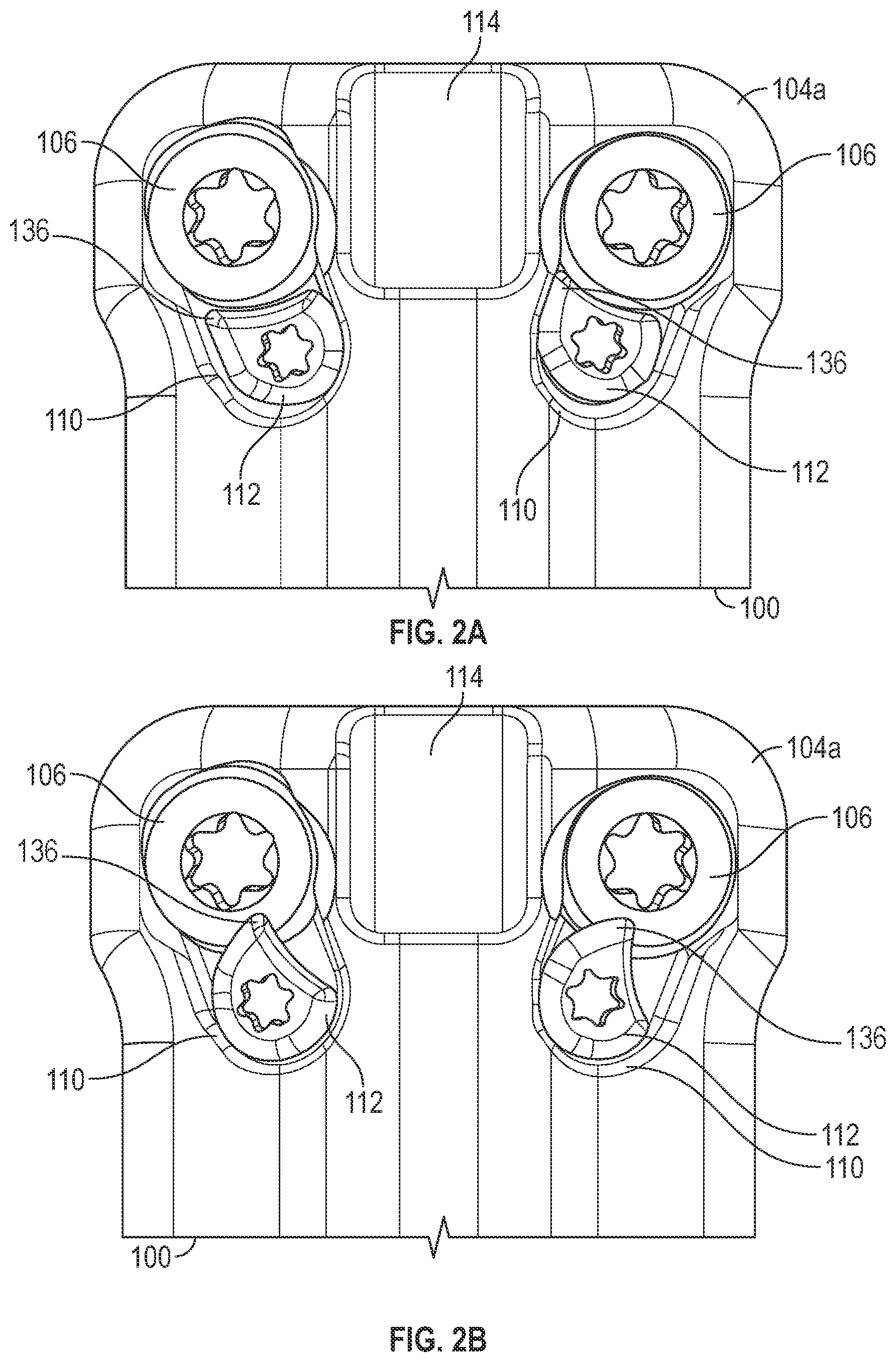 Patent US12102360 Figure 3 – Compressible cervical plate