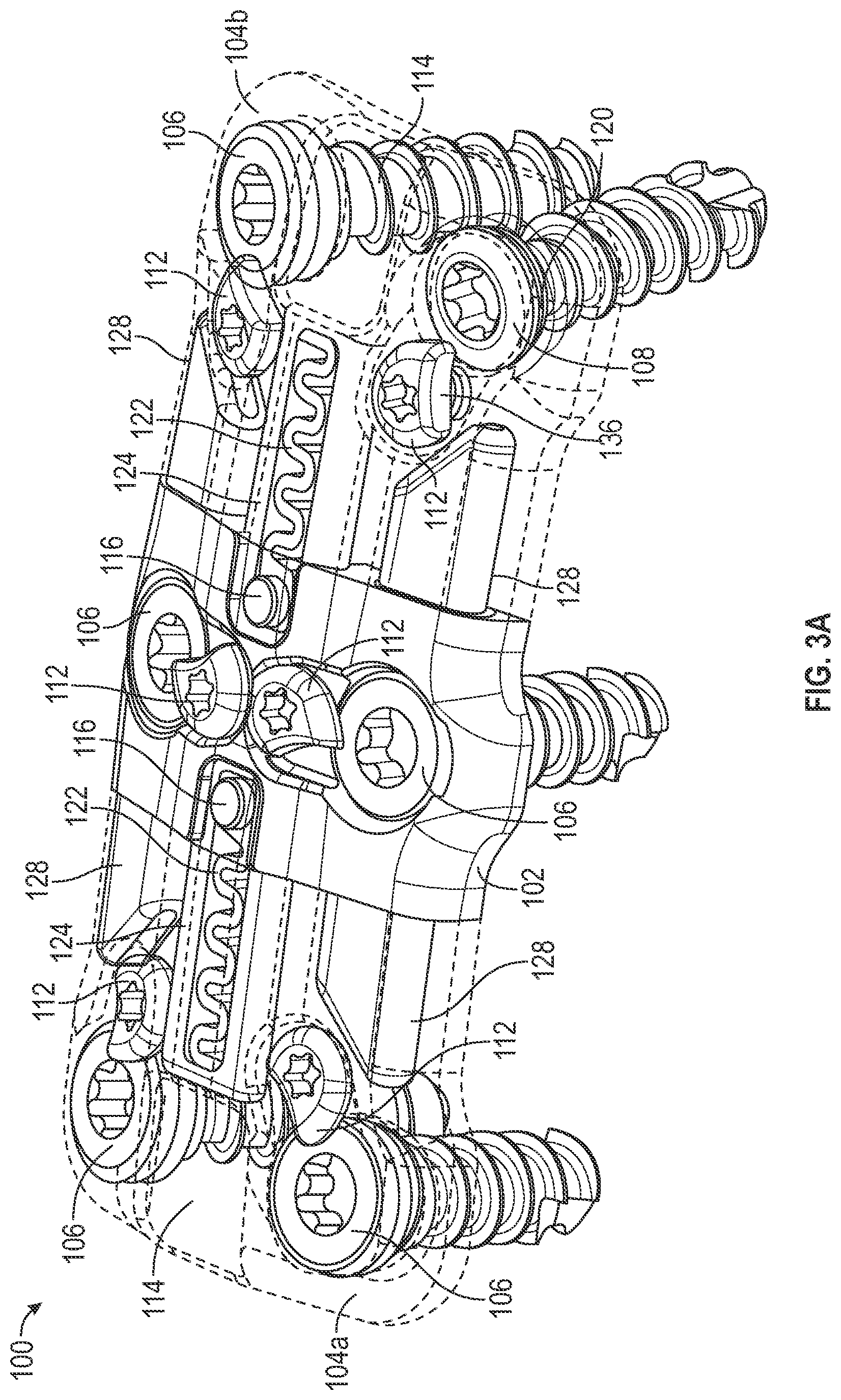 Patent US12102360 Figure 4 – Compressible cervical plate