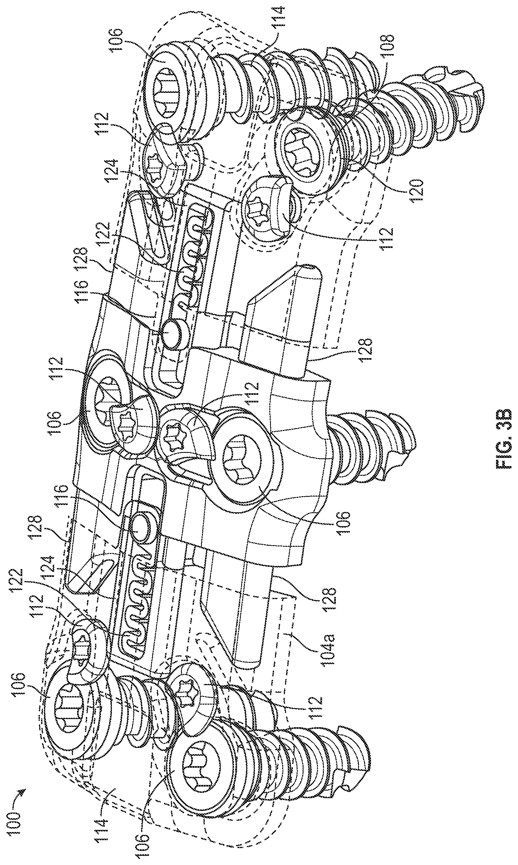 Patent US12102360 Figure 5 – Compressible cervical plate