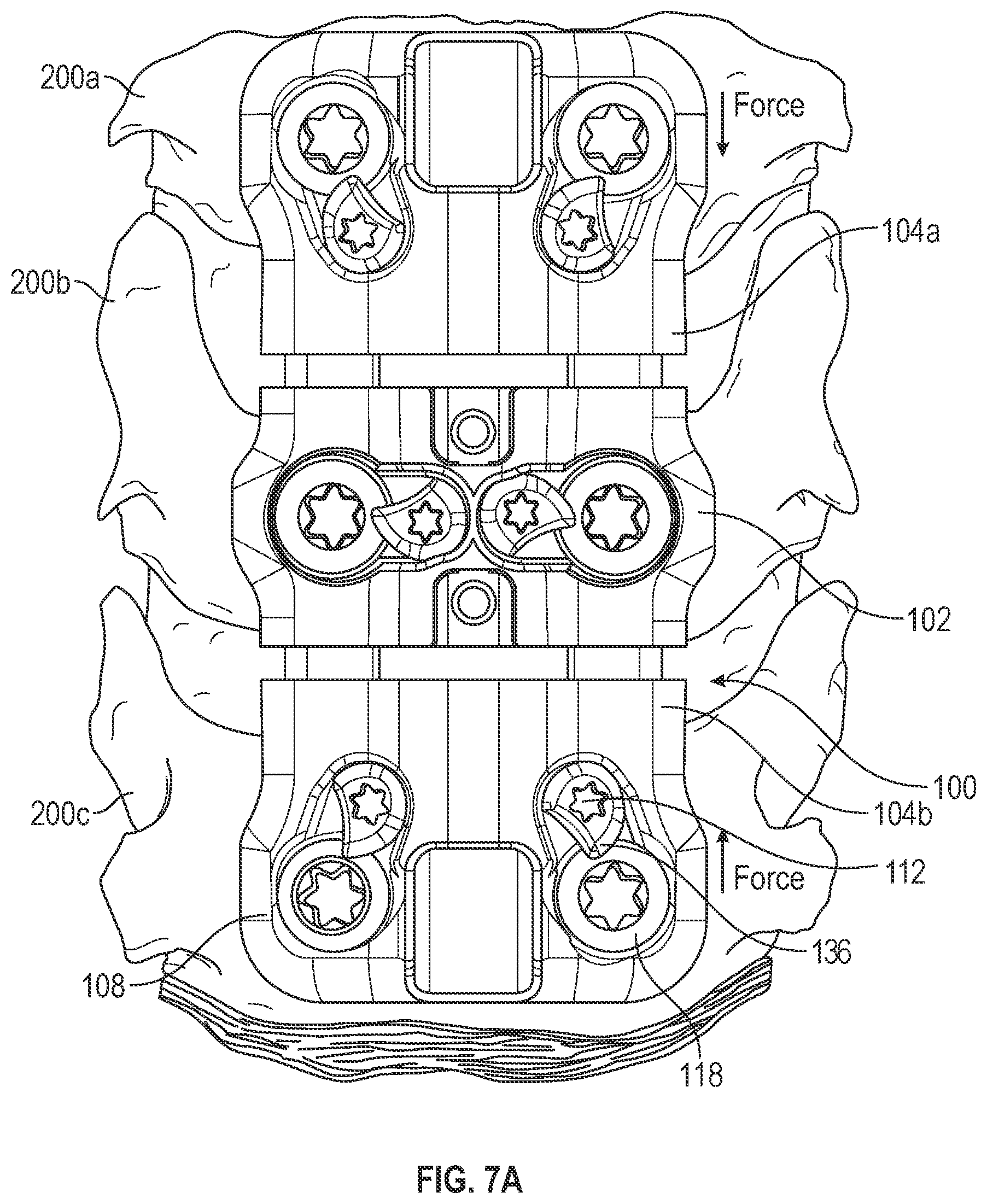 Patent US12102360 Figure 8 – Compressible cervical plate