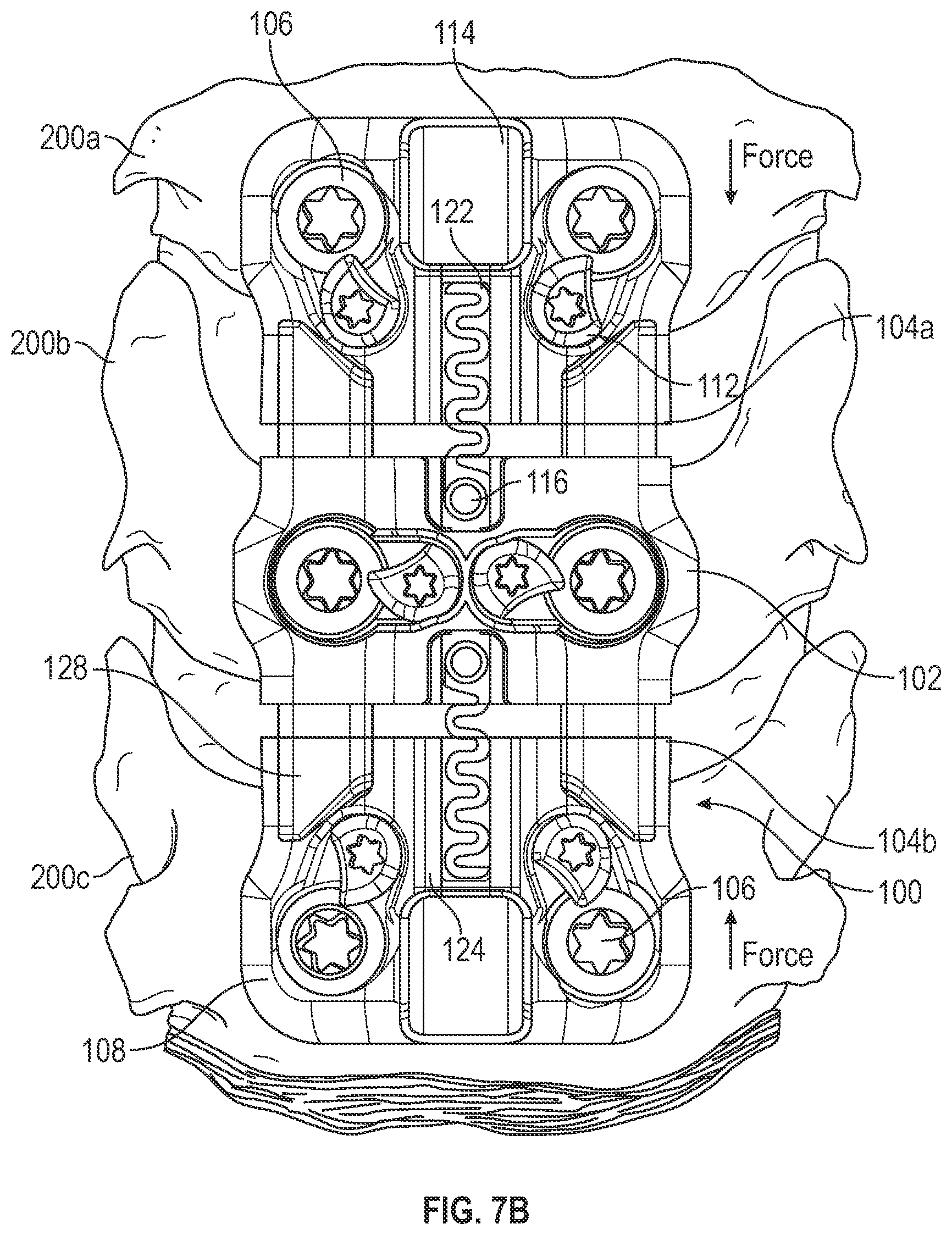Patent US12102360 Figure 9 – Compressible cervical plate