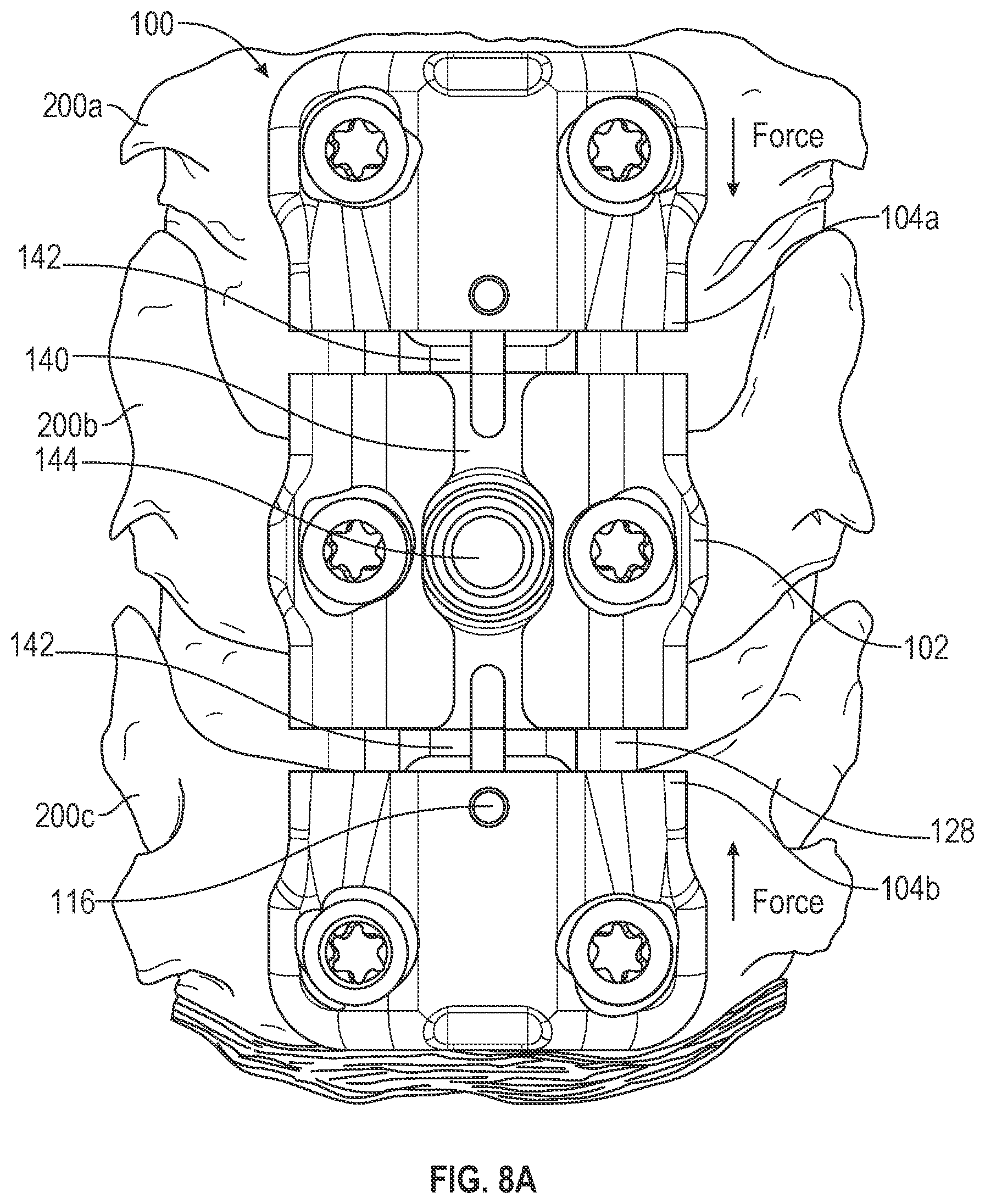 Patent US12102360 Figure 10 – Compressible cervical plate