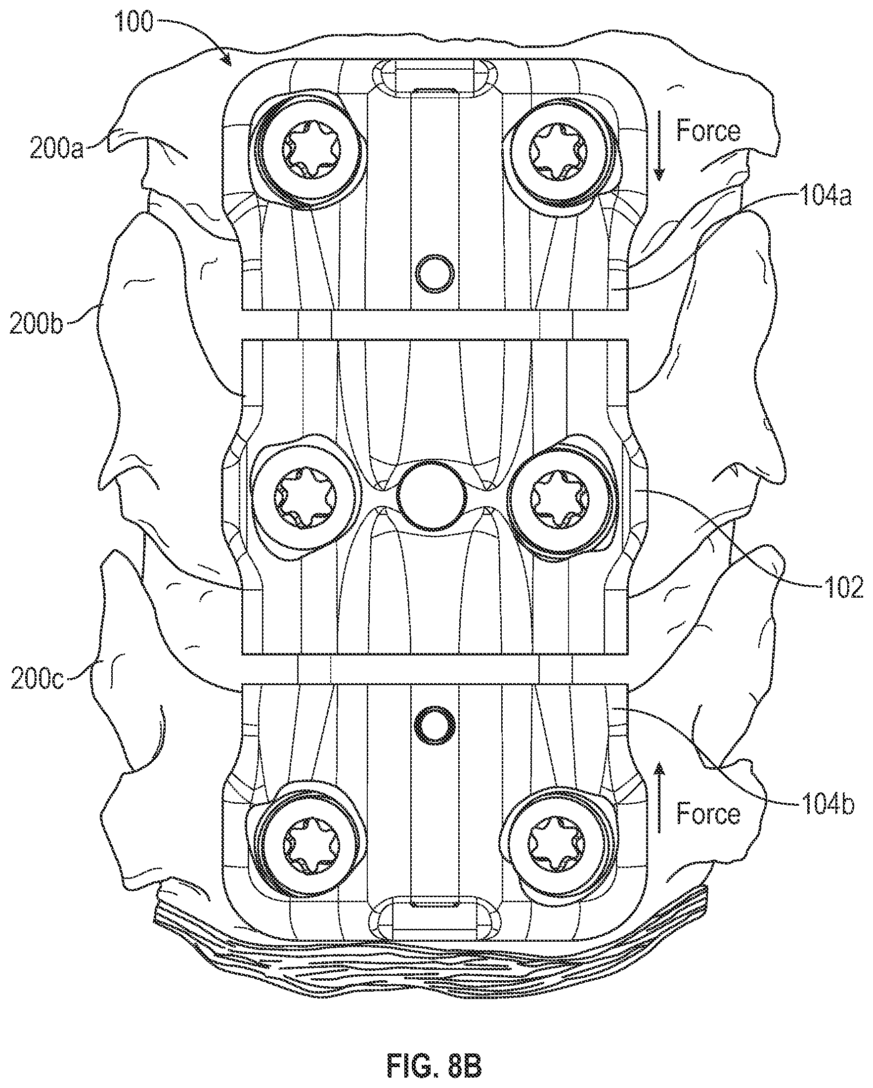 Patent US12102360 Figure 11 – Compressible cervical plate