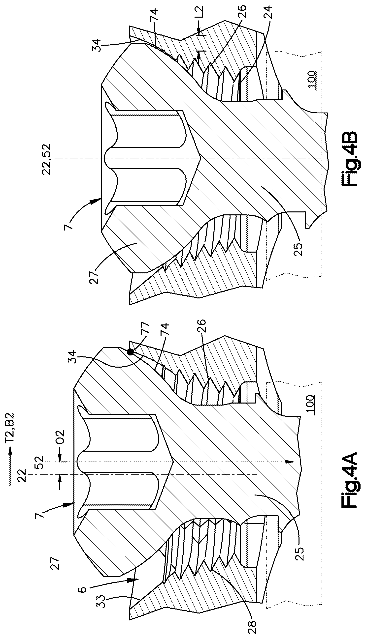 Patent US12102361 Figure 5 – Bone plates having multi-use screw holes for locking and compression screws, and related systems and methods