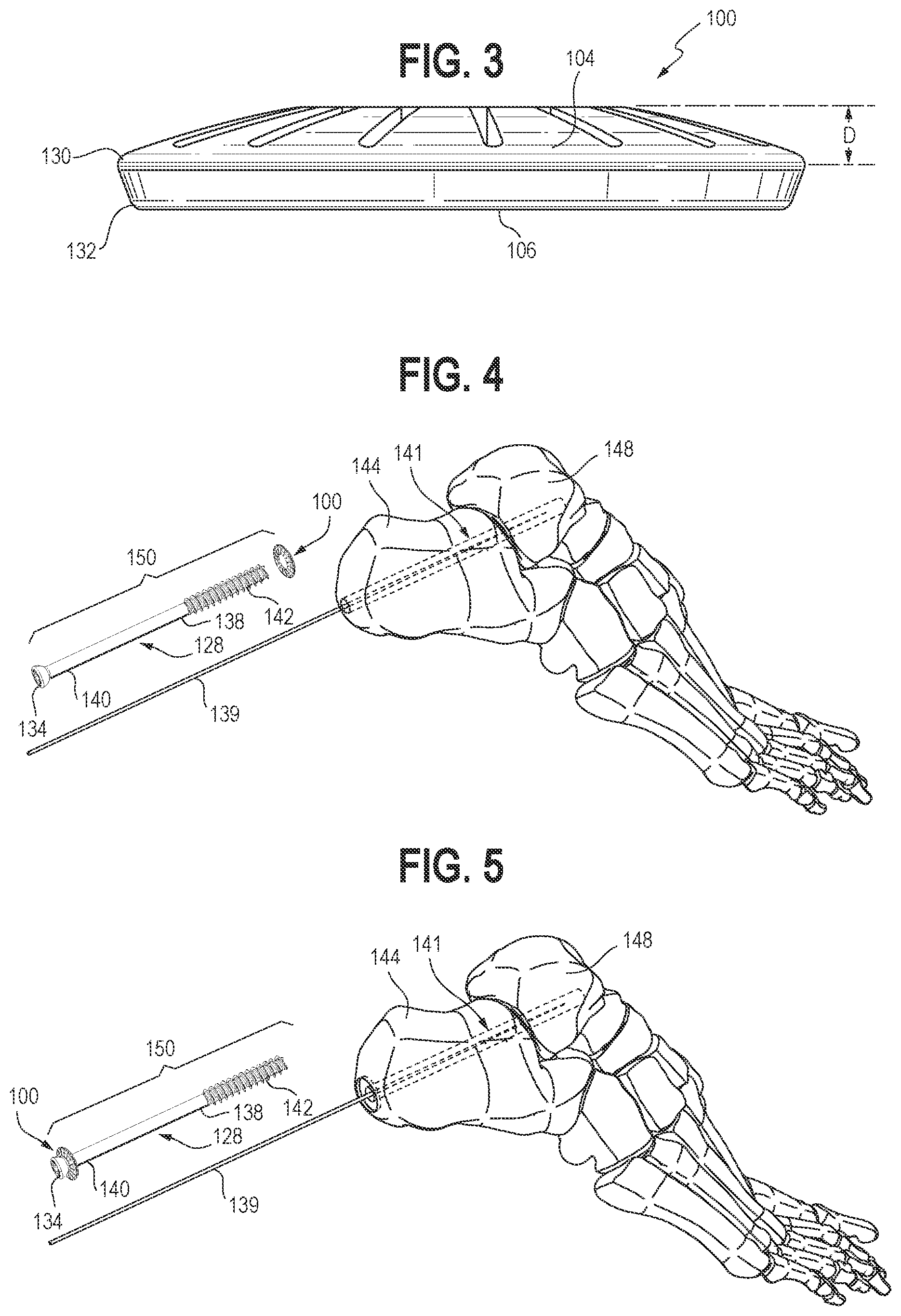 Patent US12102362 Figure 2 – Compression device, kit, and method