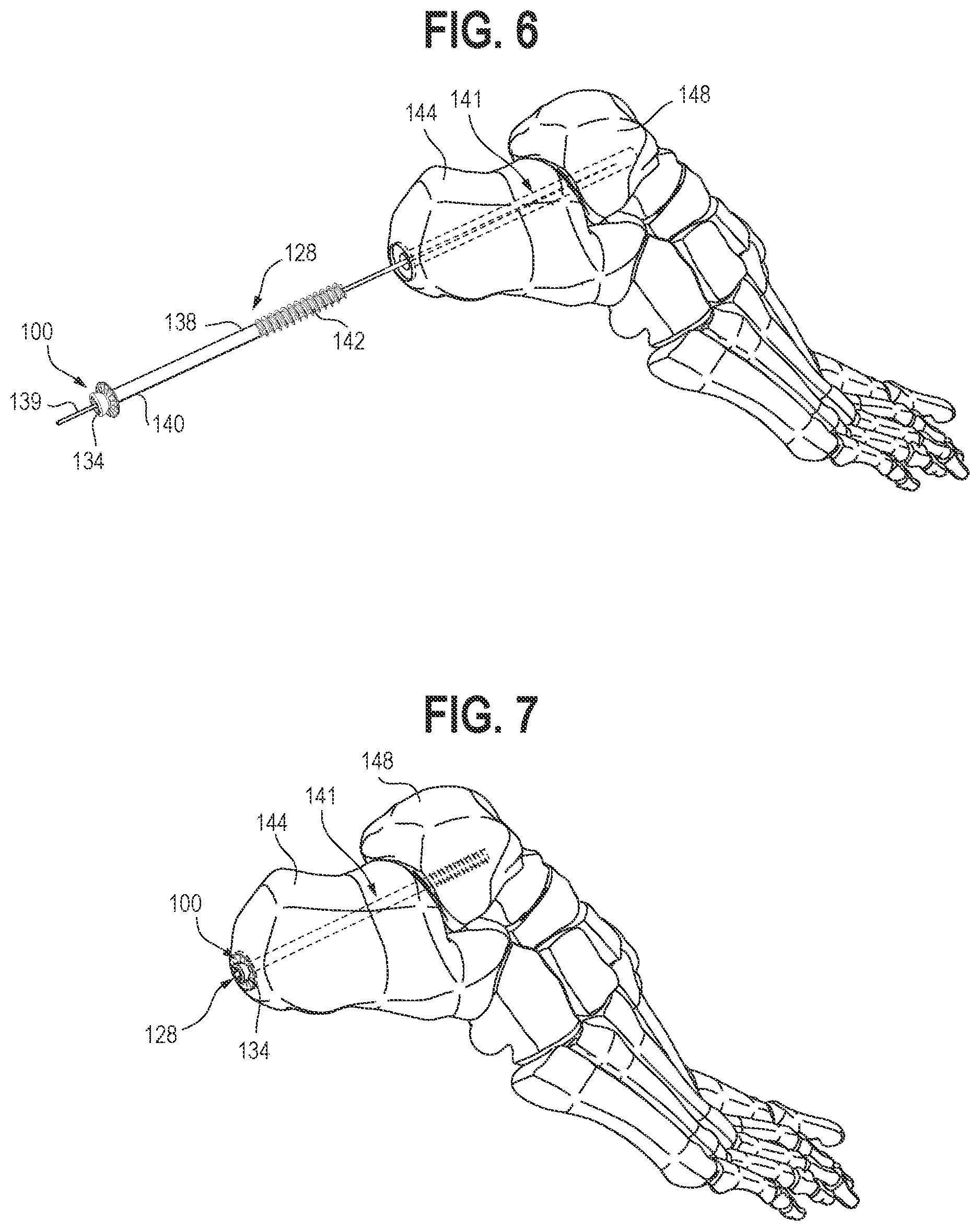Patent US12102362 Figure 3 – Compression device, kit, and method