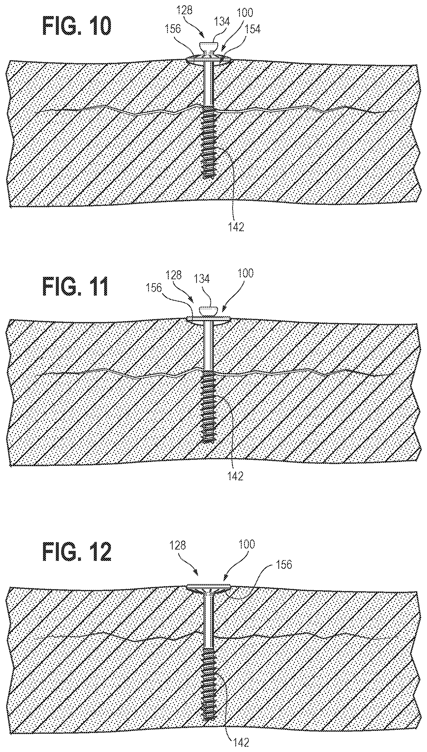 Patent US12102362 Figure 5 – Compression device, kit, and method
