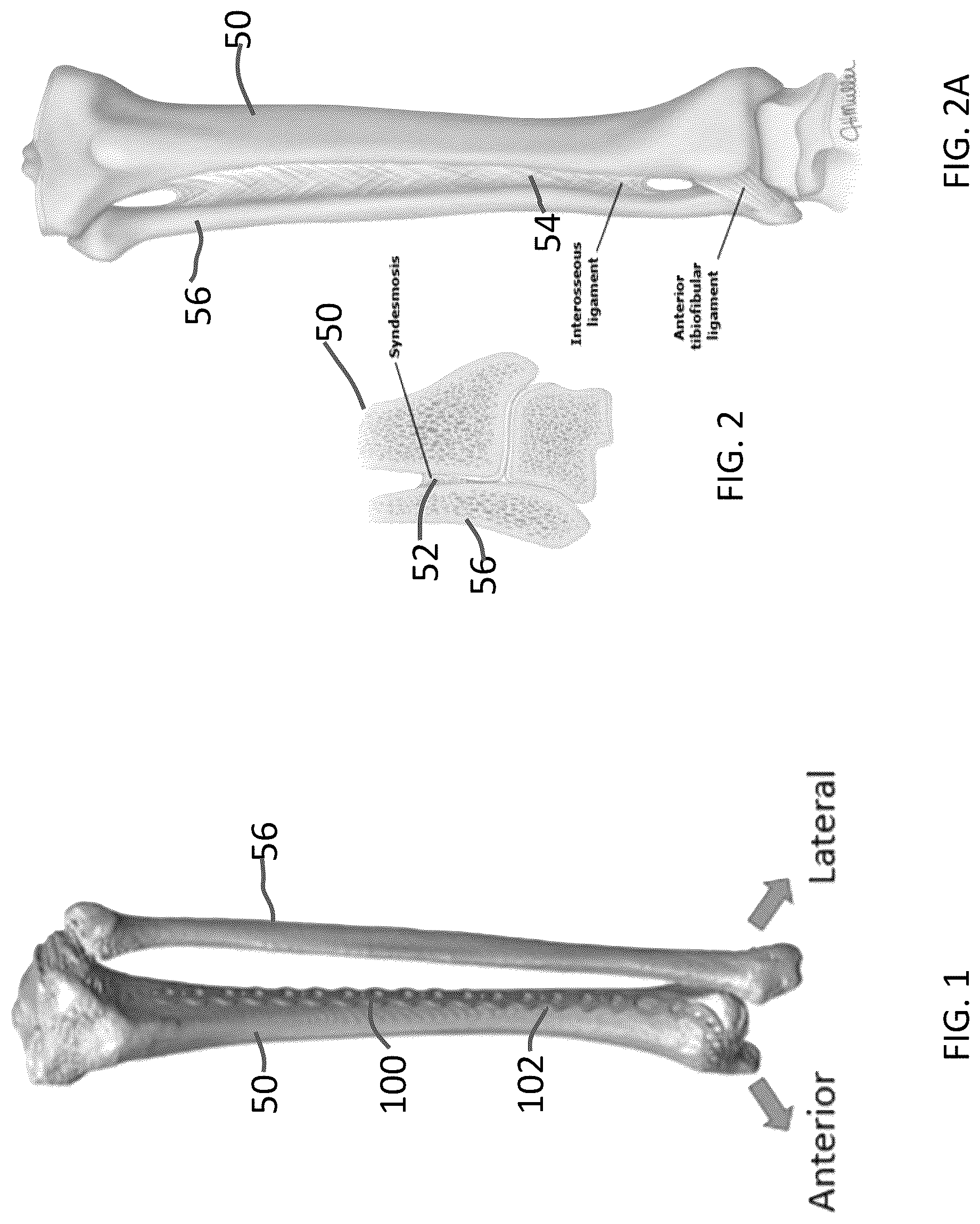 Patent US12102363 — Distal tibial plating system — Figure 1