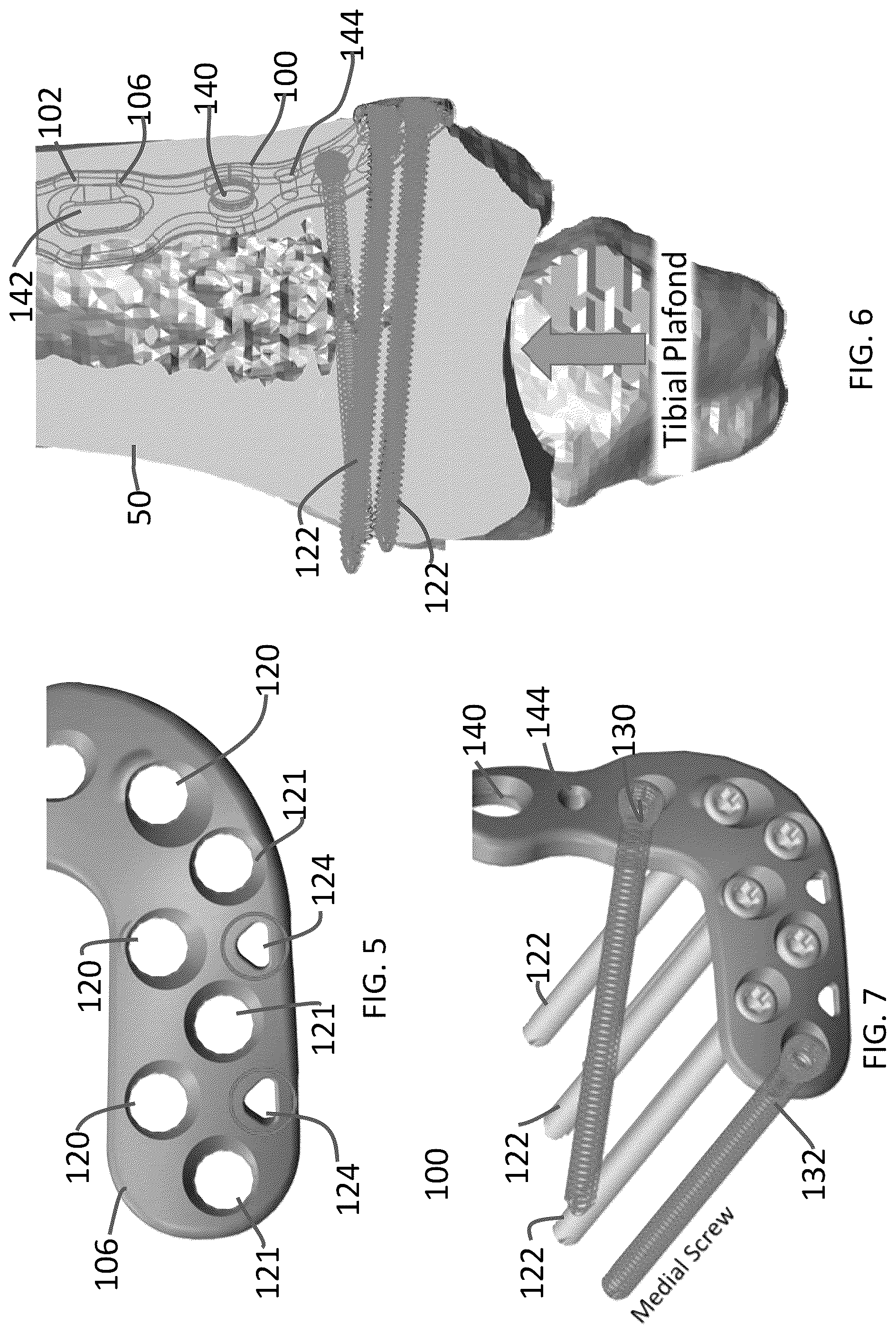 Patent US12102363 Figure 3 – Distal tibial plating system