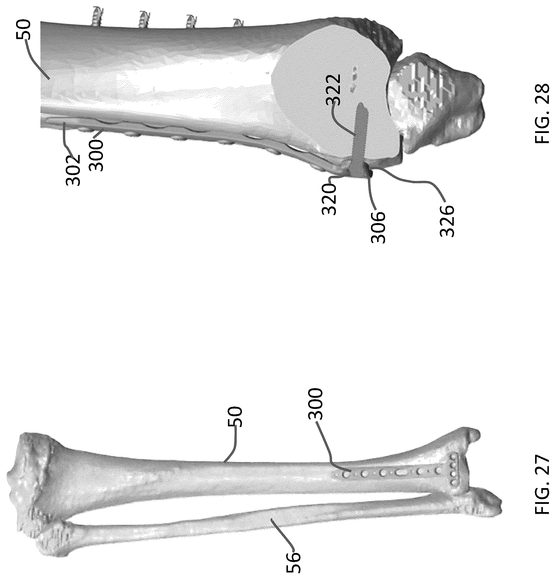 Patent US12102363 Figure 12 – Distal tibial plating system