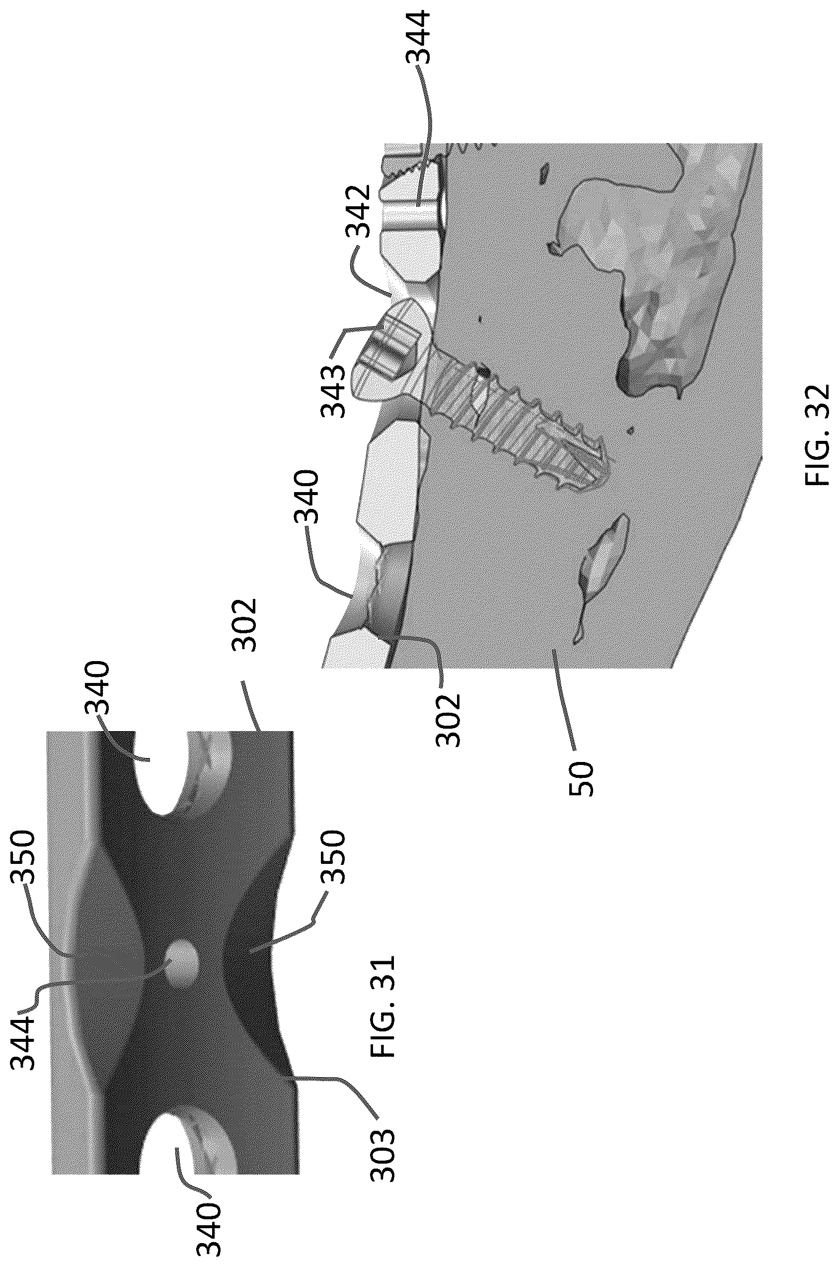 Patent US12102363 Figure 14 – Distal tibial plating system